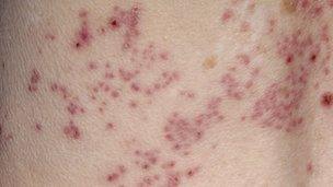 Shingles rash