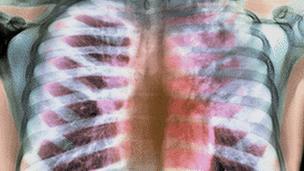 tuberculosis x-ray