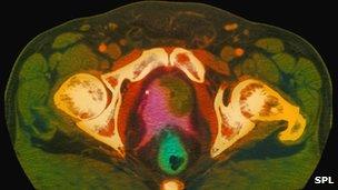 Scan of human pelvis showing prostate cancer (dark green)