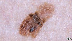 Melanoma or serious skin cancer