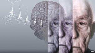 Alzheimer's disease