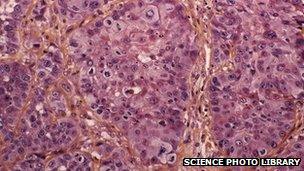 Cells taken from an oesophagus cancer patient