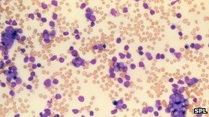 Cancerous white blood cells