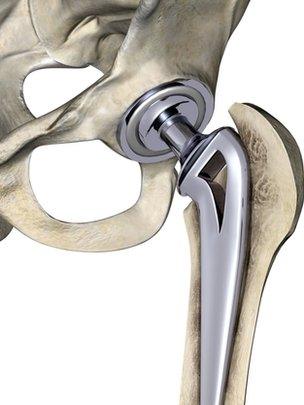 Hip replacement