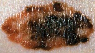 Melanoma