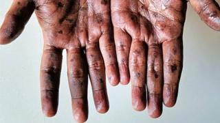 Monkeypox rashes