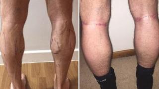 Mark Henderson's legs before and after