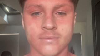 A close up of a man's face. he has brown ahir and there are dry red patches around his eyes, mouth and down his neck.