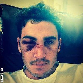 Craig Kieswetter tweeted a picture of his injuries