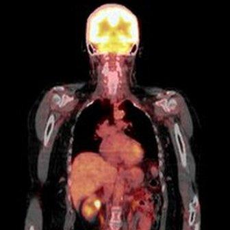 Combination PET/CT scan to pick up cancer