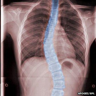 scoliosis