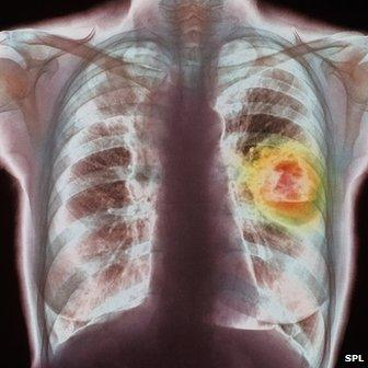 Coloured chest X-ray showing lung cancer