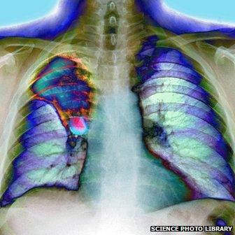 X-ray of lungs