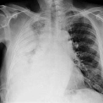 Mesothelioma tumour