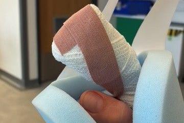 A heavily bandaged index finger with a foam support. A hospital setting can be seen in the background.