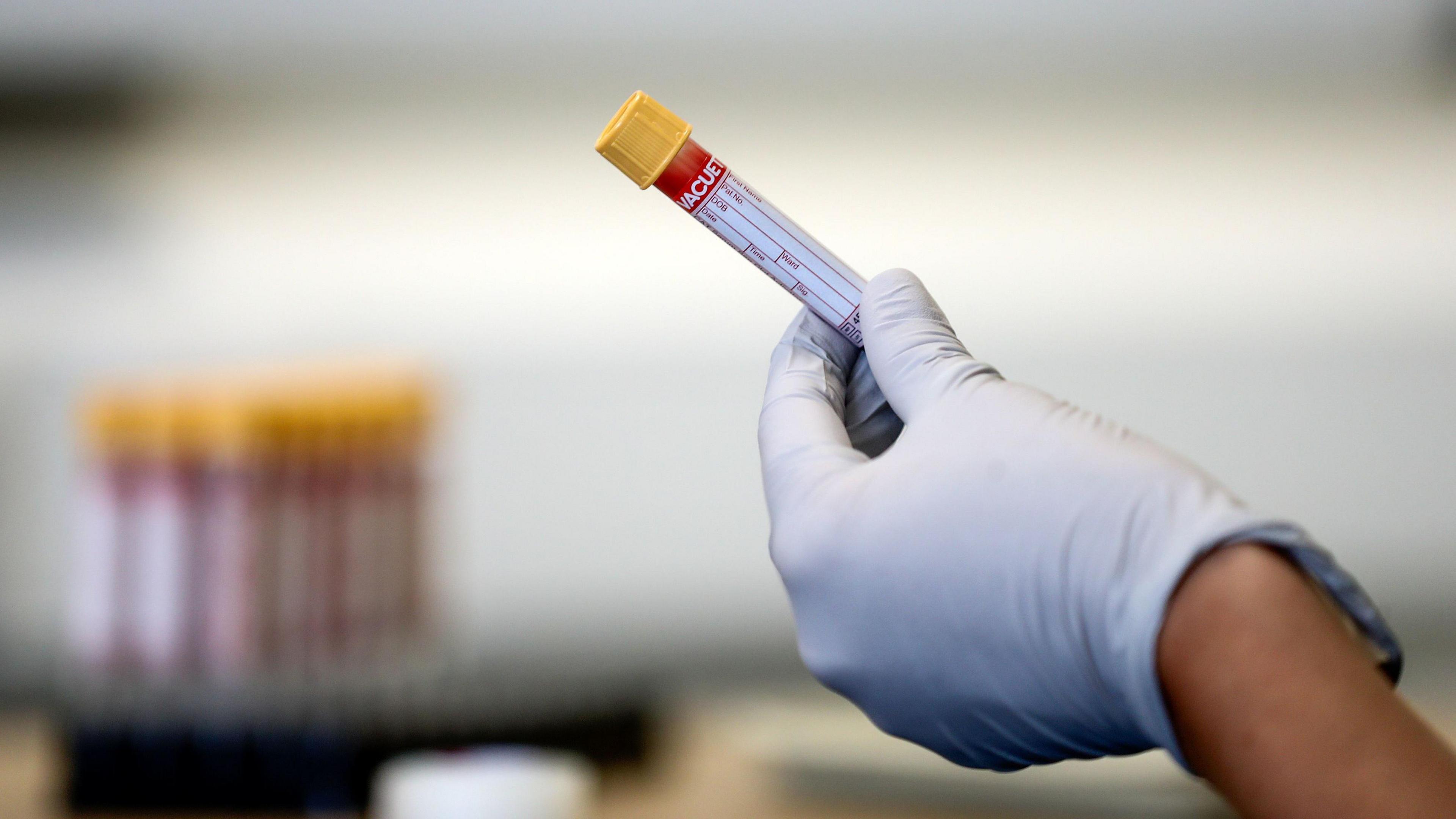 A test tube containing a blood sample