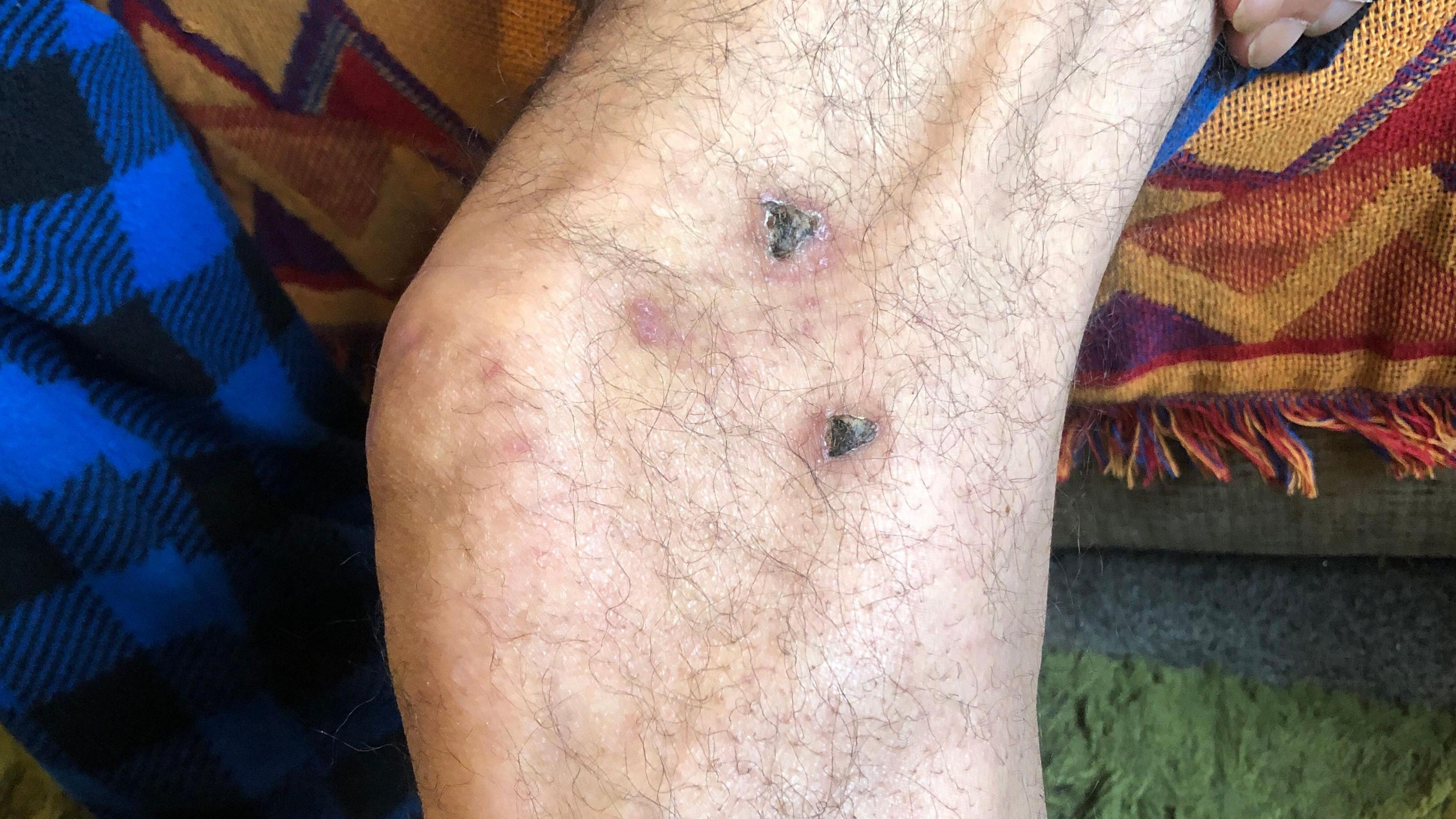 The picture shows Mr Macey's knee, which features two big scabs parallel to each other. Some smaller scars can also be seen around it.