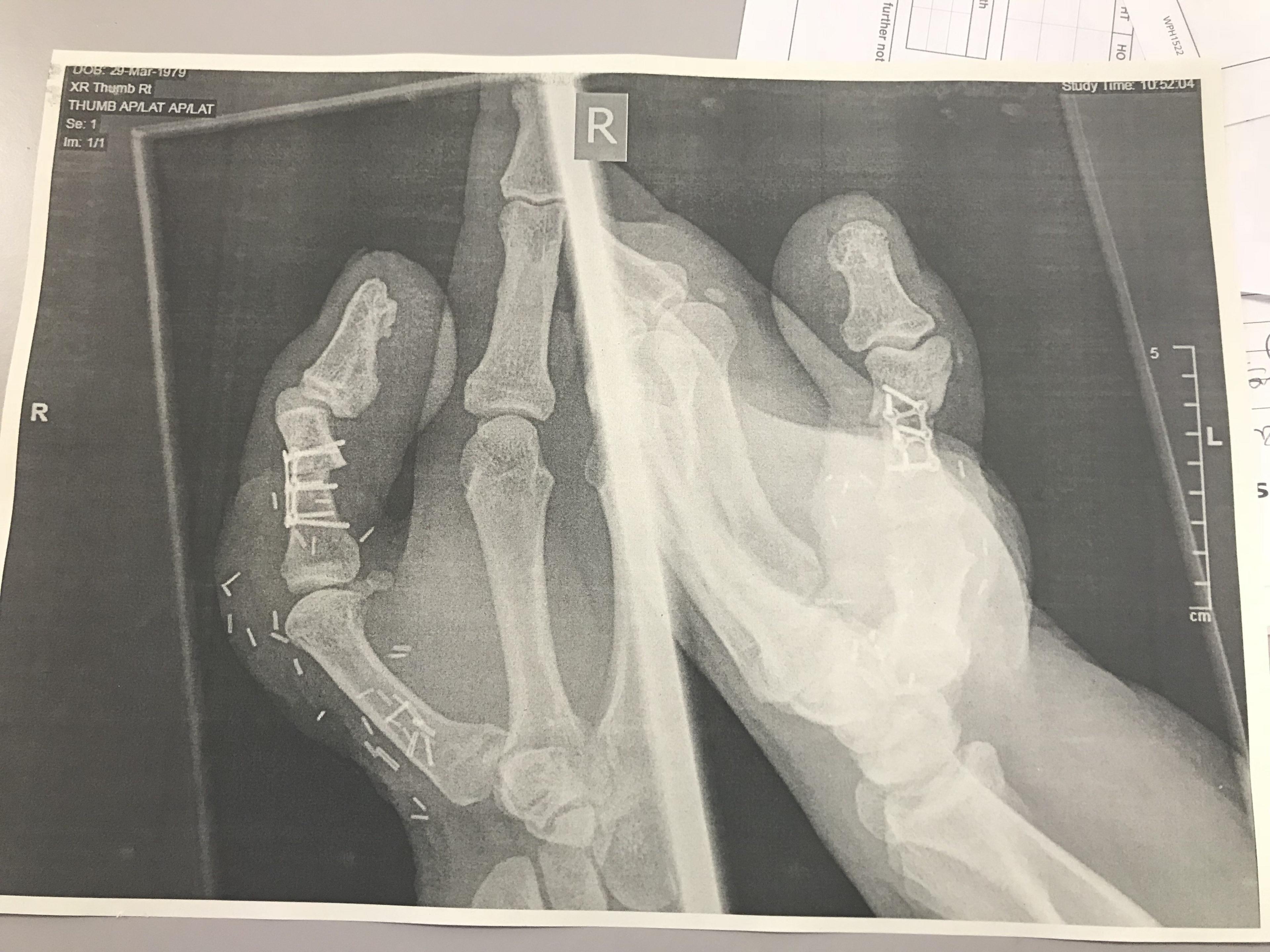 David Lee X-ray of hand