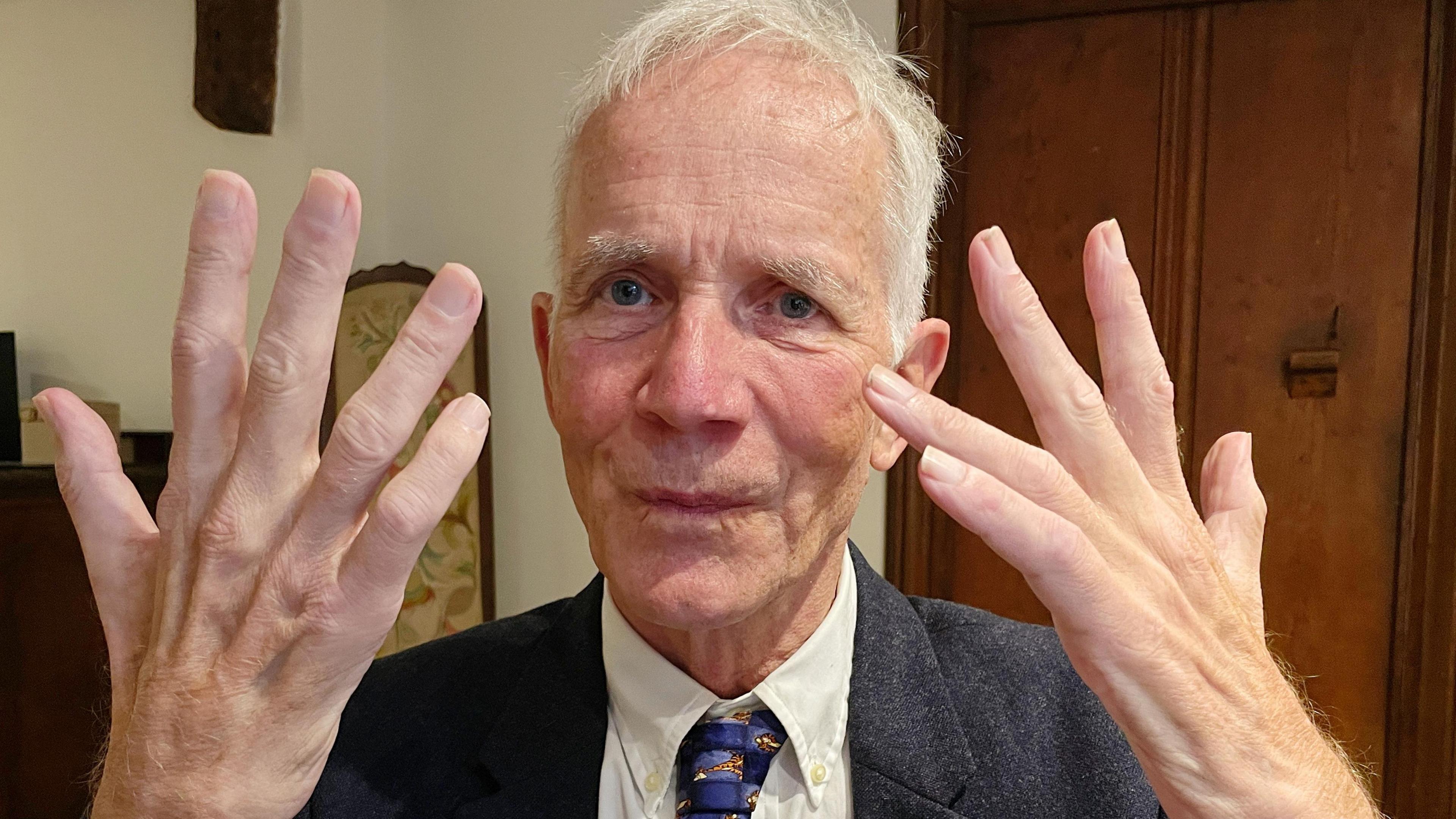 Graham Watson holds up his hands which show signs of muscle wastage caused by Motor Neurone Disease, that mean he can no longer operate on patients. 