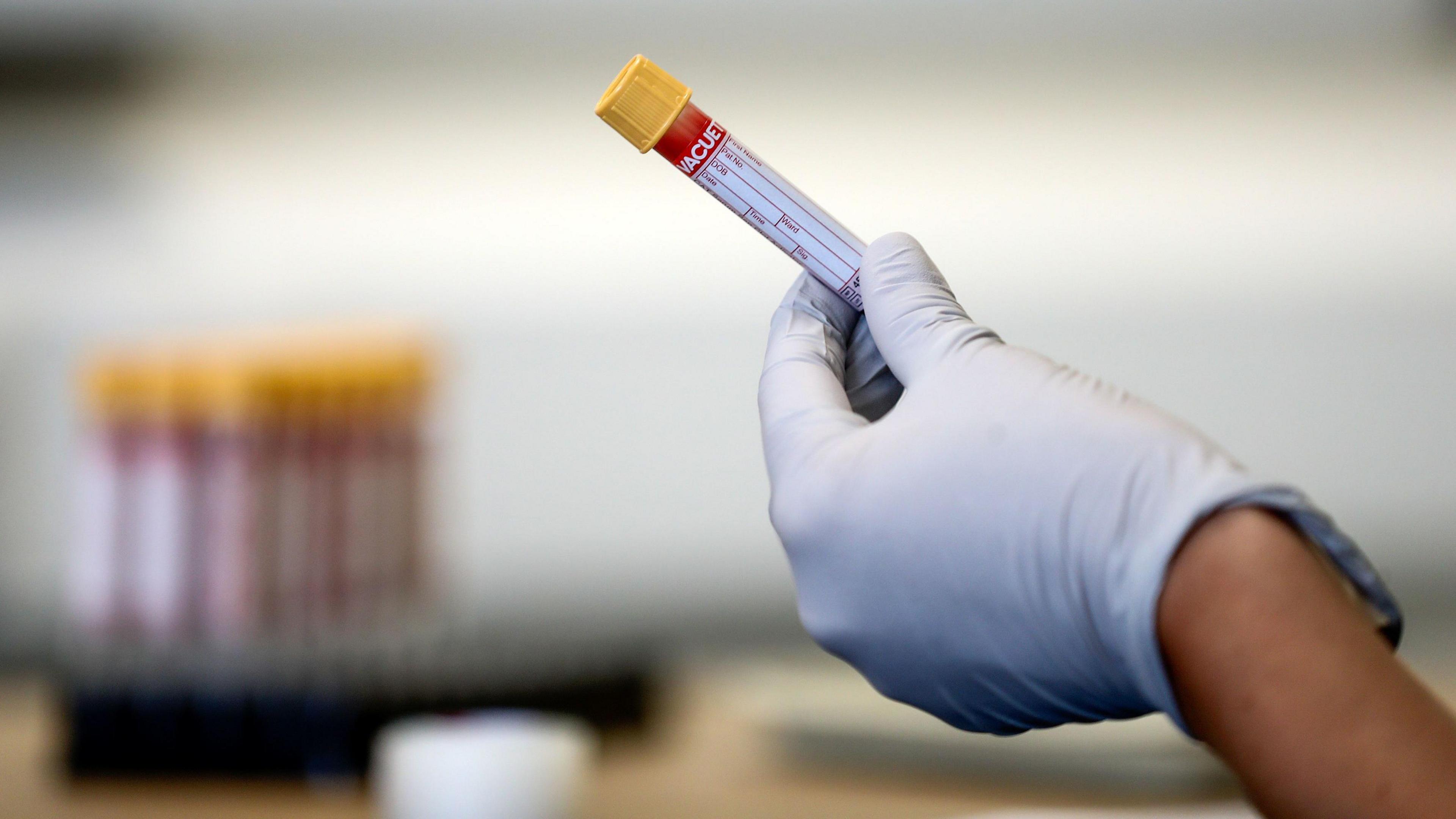 A hand in a white latex glove holding a of a test tube containing a blood sample, from a prostate cancer screening