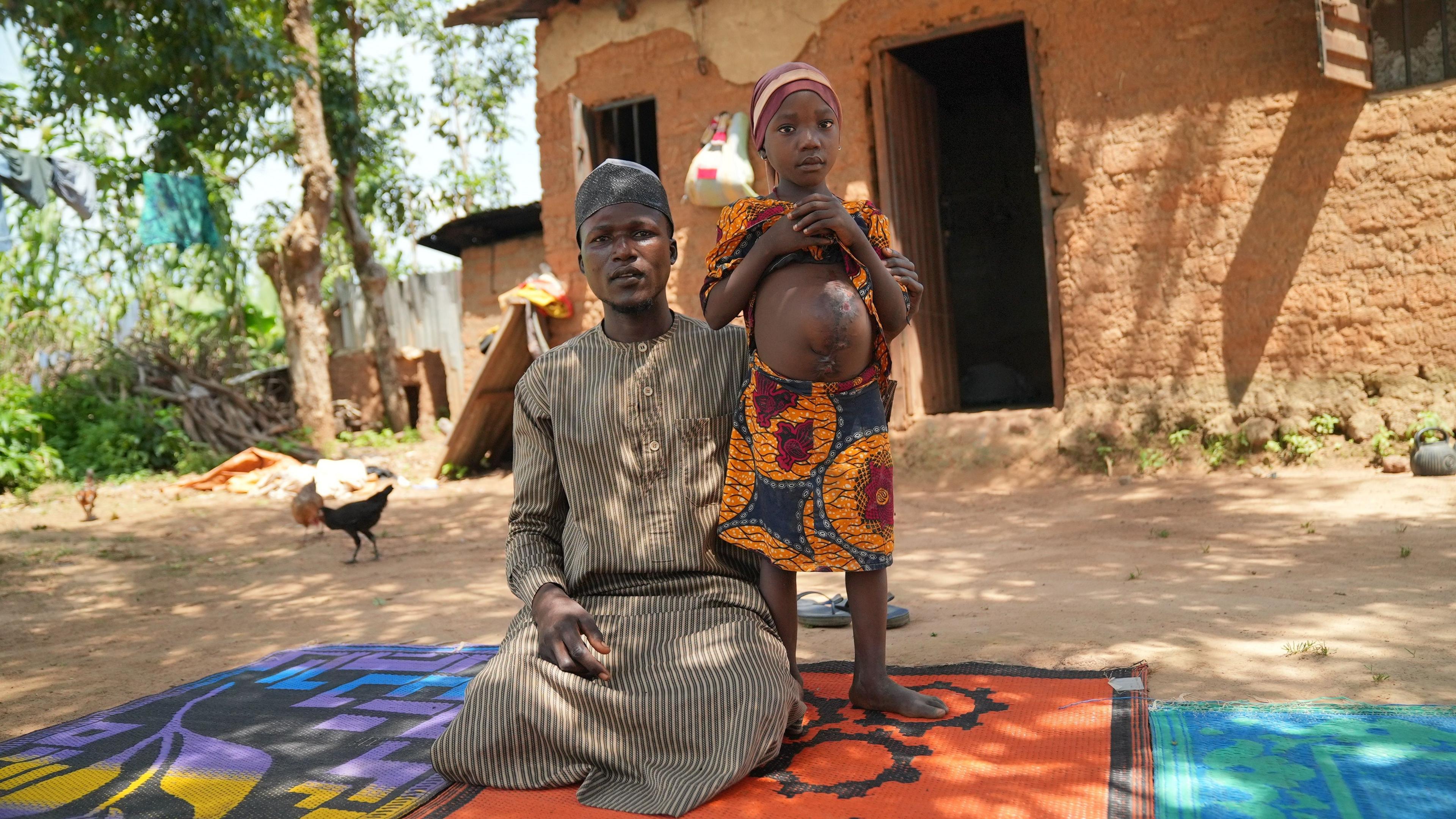 Masud Abdulrasheed is sitting while his daughter Zaharau is standing next to him, showing her wound