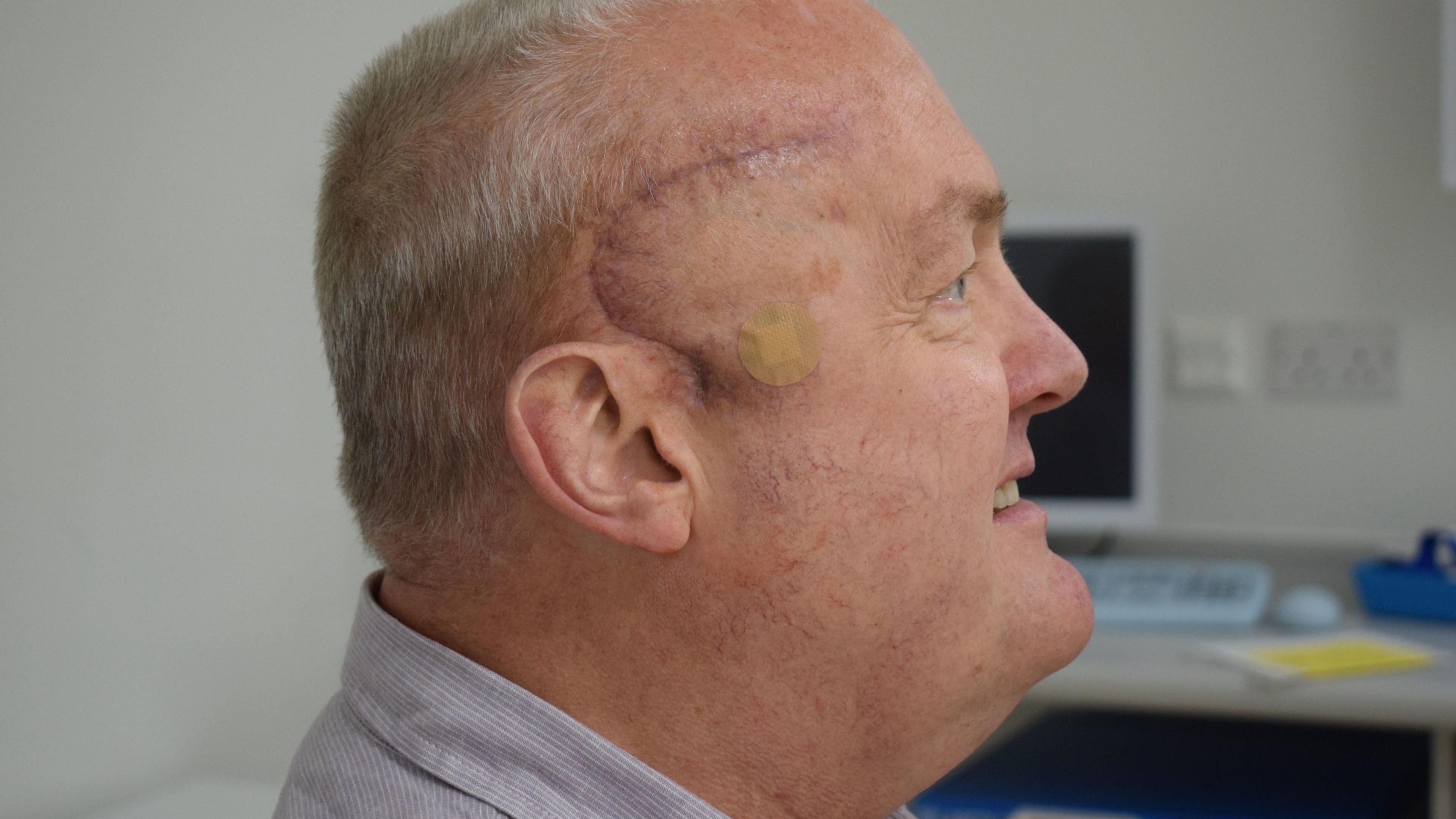 Side profile of Paul looking to the right. His scar from brain tumour surgery can we seen clearly and is thin dark purple line in an almost crescent shape. It begins just above his right eyebrow, travels back to his hair, curving down to reach his ear. The scar stops just in front of the middle of Paul's ear. His background is blurred but looks to be a medical setting with plain white walls and a computer. 