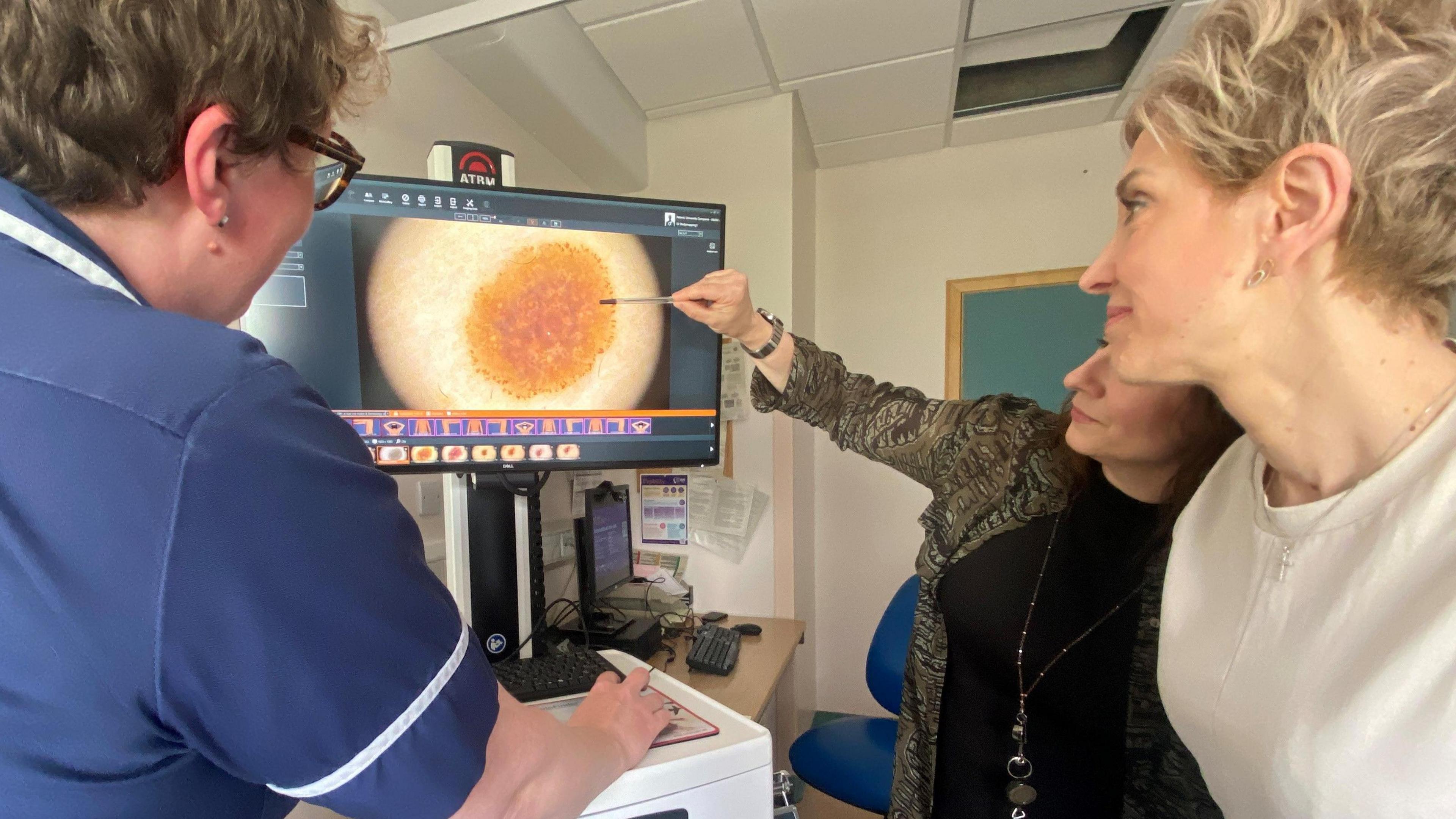 Three people are facing towards a monitor that has a photograph of a mole on it. The person on the far right is holding a pen and pointing at the diagram.