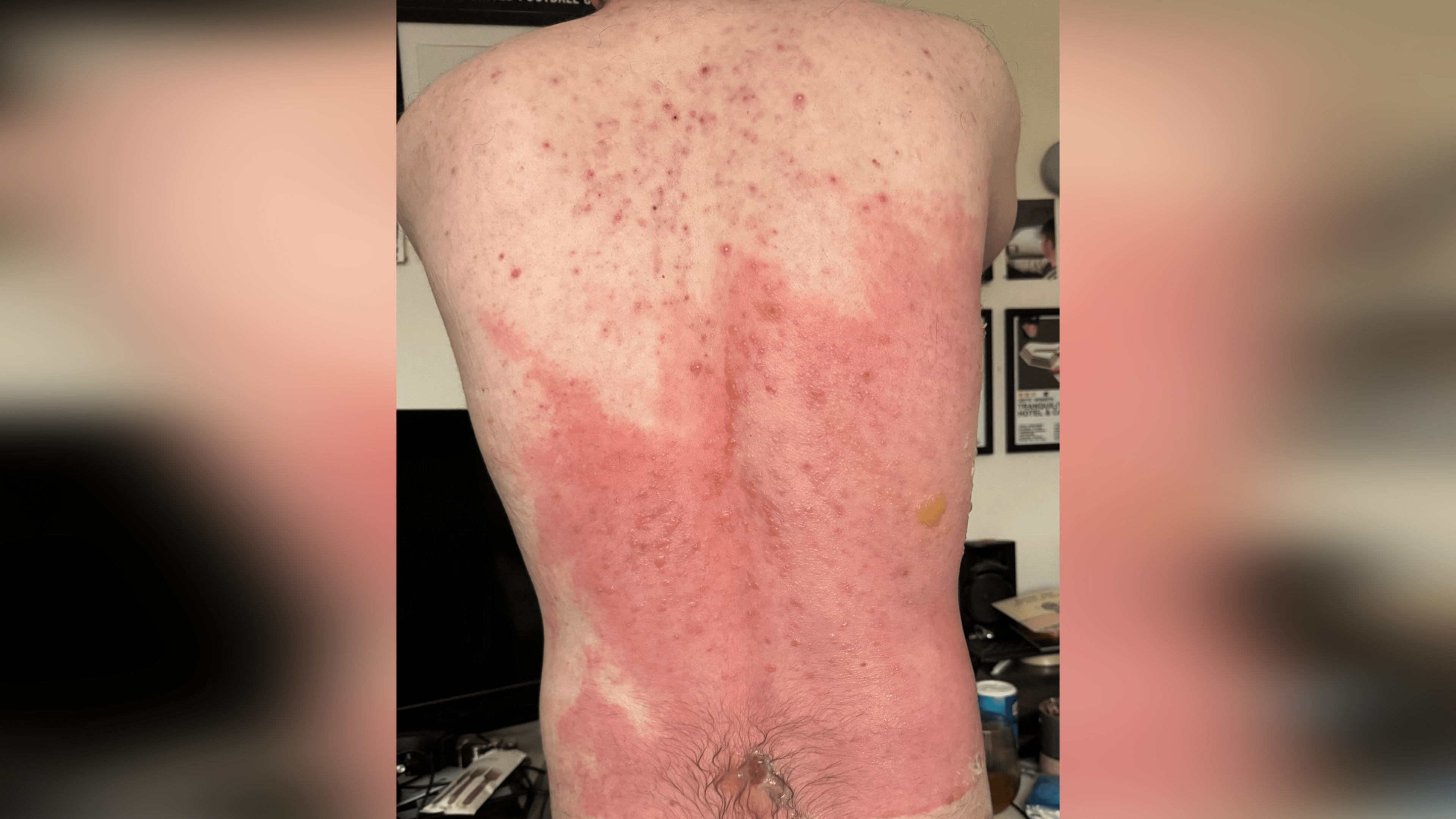 A man's back with a red burn covering the mid to lower back. There are blisters on some of the skin.