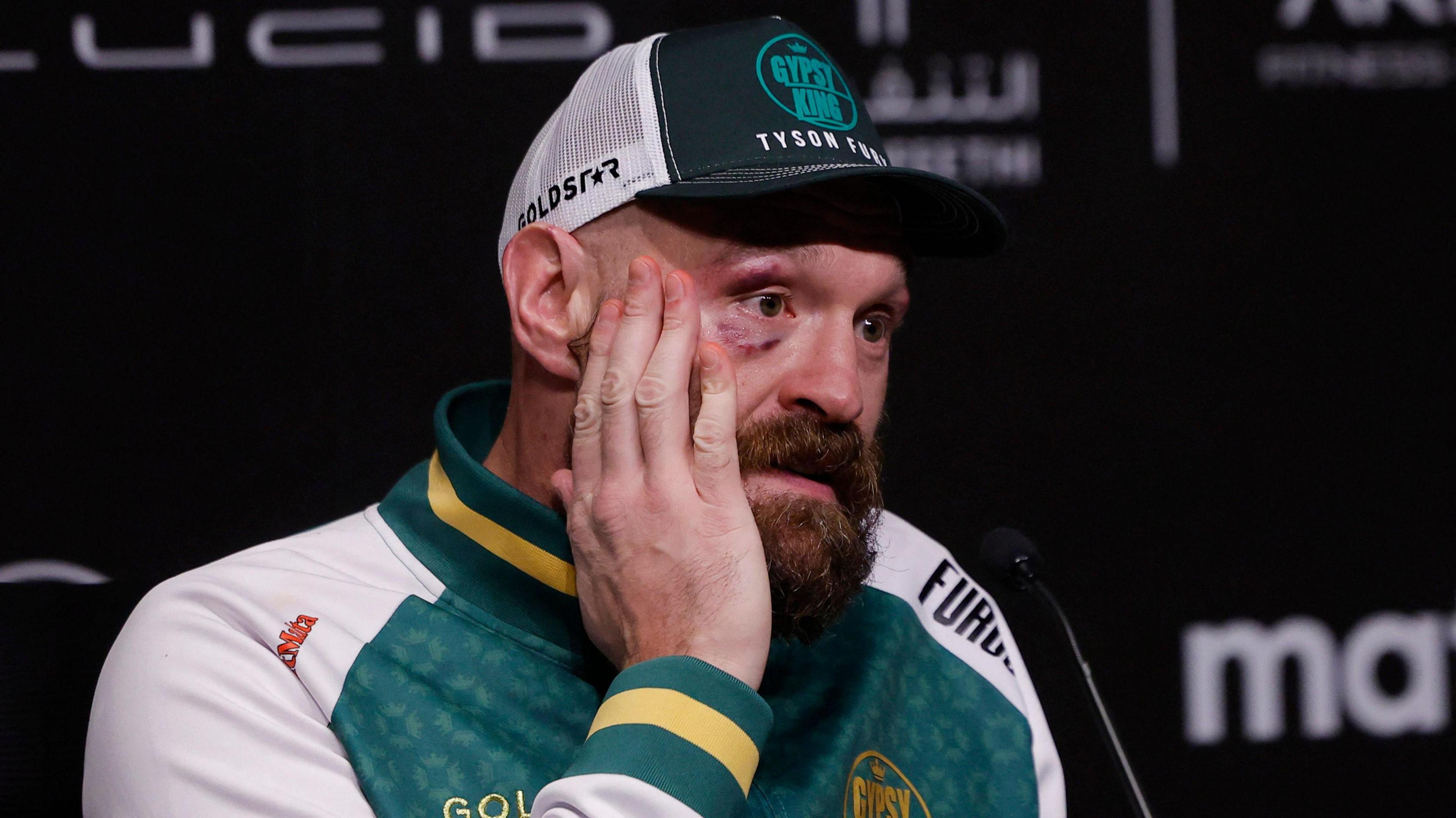 Tyson Fury, battered and bruised, speaks at a news conference