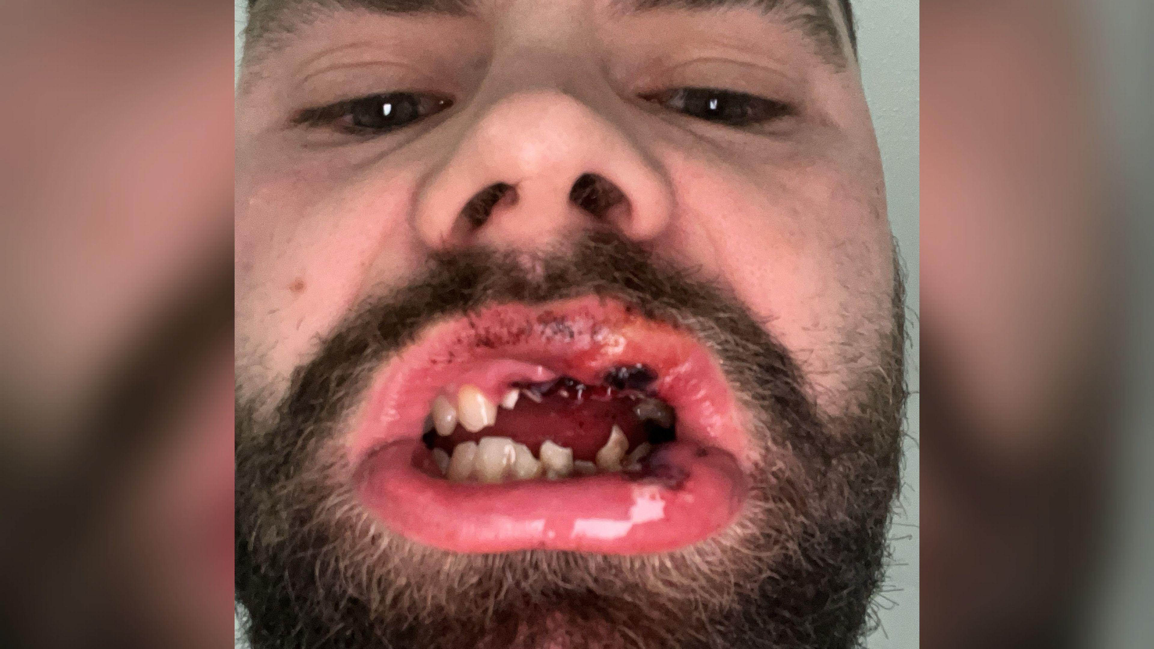 A close up of a bearded man's mouth which has dried blood in it and damaged teeth.