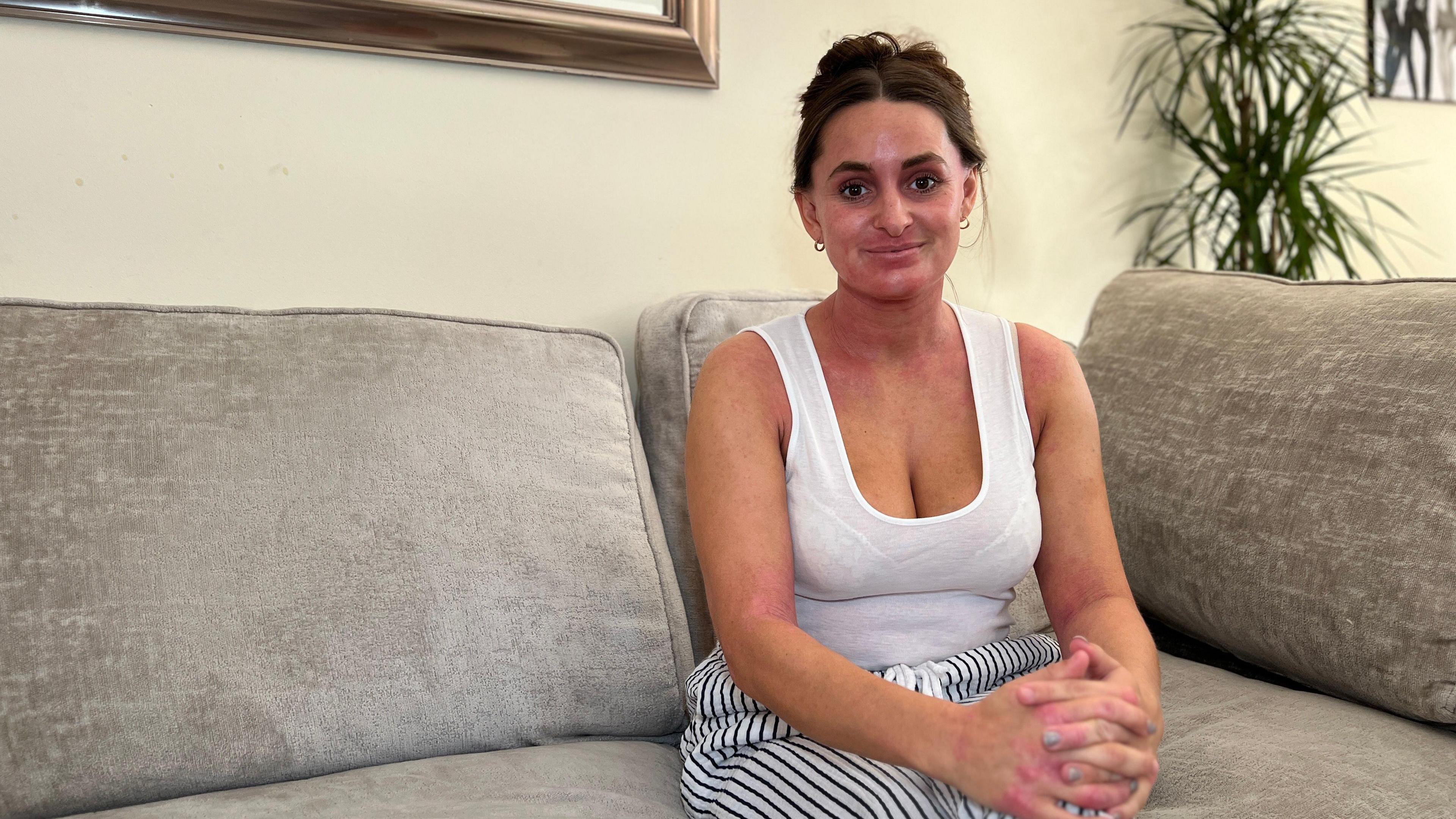 Elise-May looks at the camera while sitting on a grey sofa. She is wearing a white pyjama top with white and black striped pyjama bottom. She has dark red patches on her face, neck and arms where the skin has reacted badly to coming off the creams.