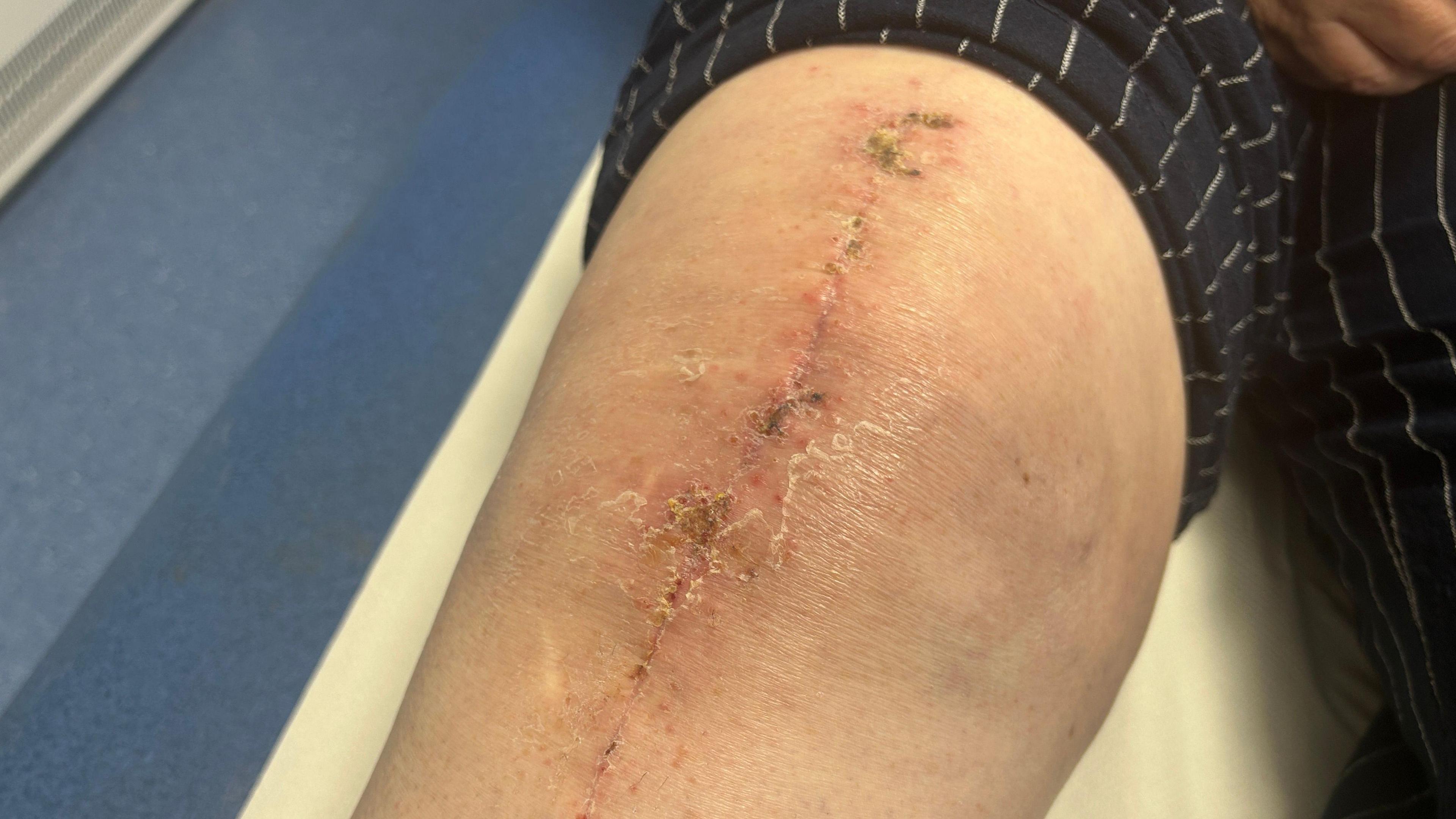 A knee with a scar following knee replacement surgery