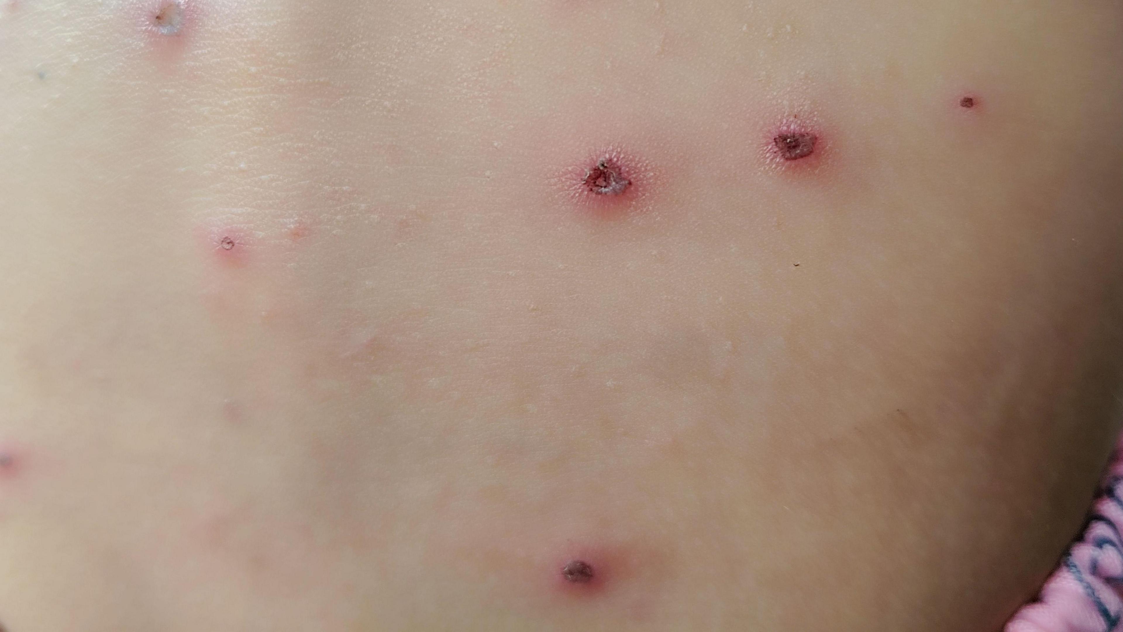 A close up of spots on a back.