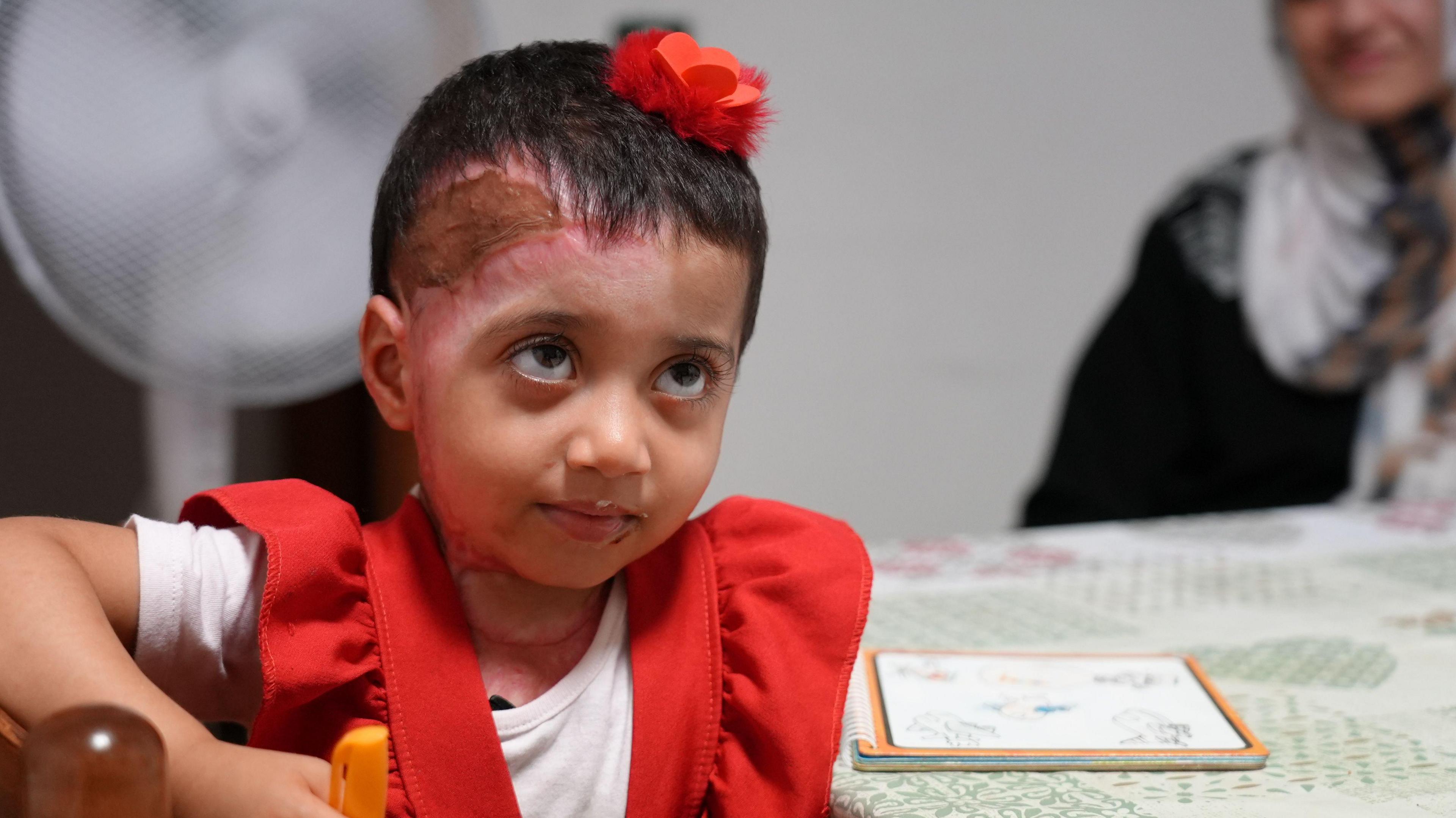 Zeina sits at a table in a red dress; an injury to the skin on her head is visible