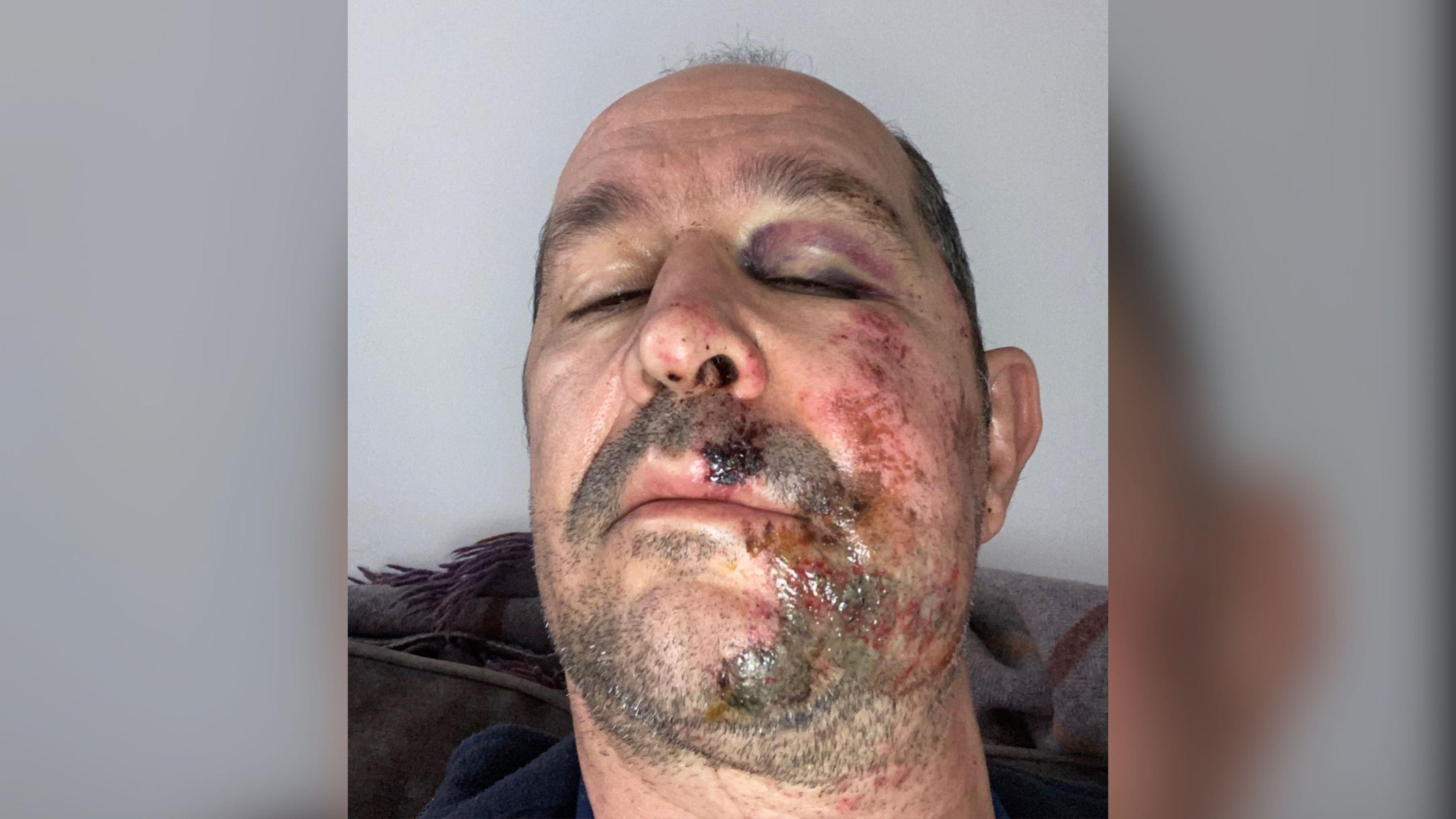 A selfie of a man with a bloody and bruised face.