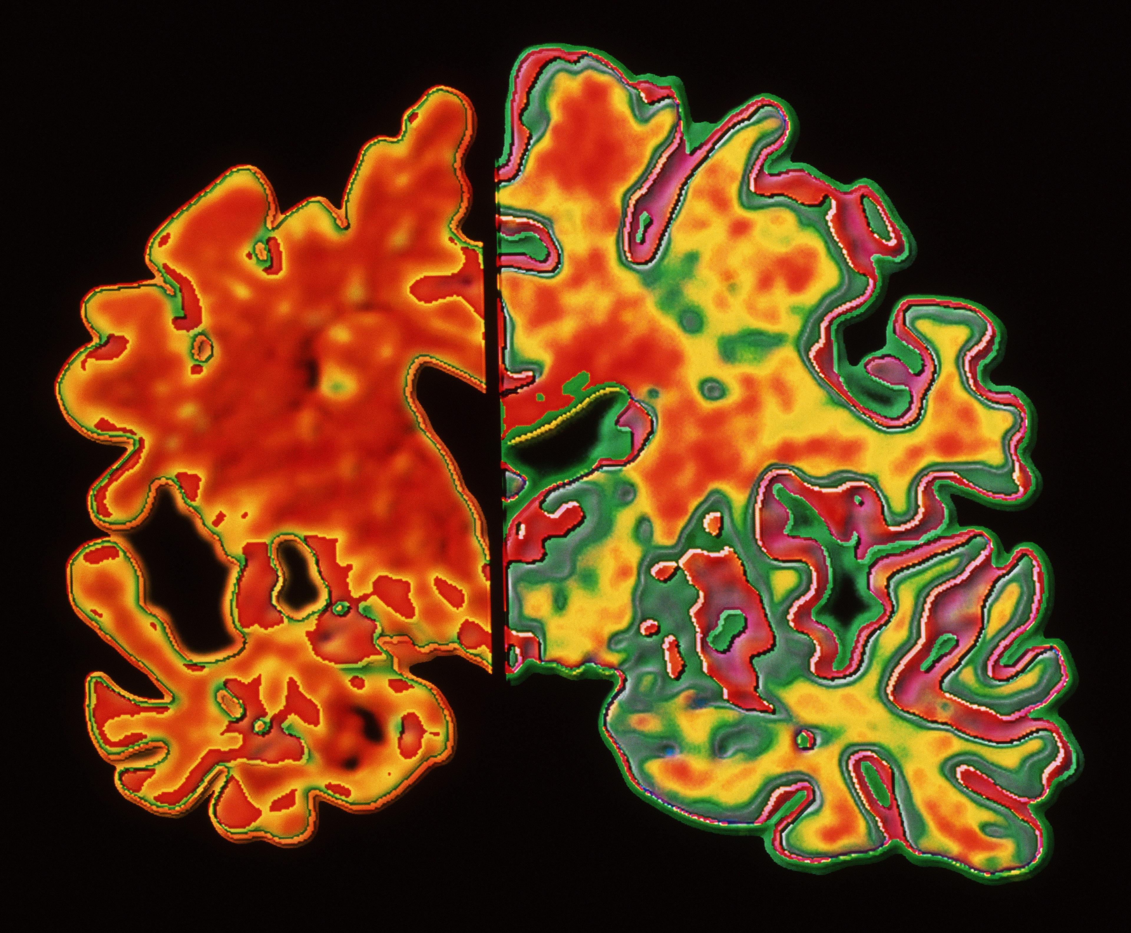 Comparative images of the brain of a dementia patient and a non-dementia patient