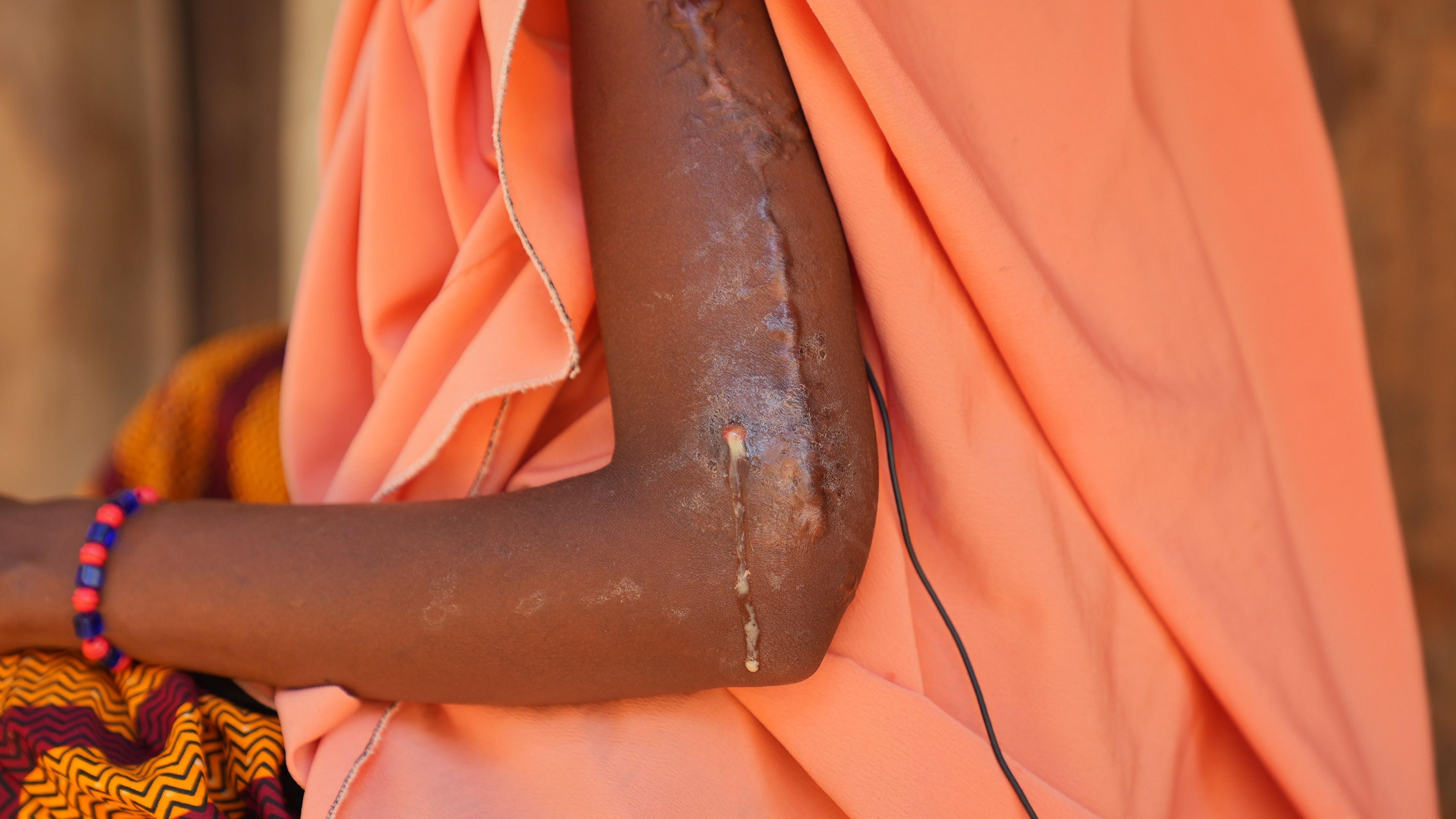 Aisha Buhari sitting, with the wounds on her arm visible