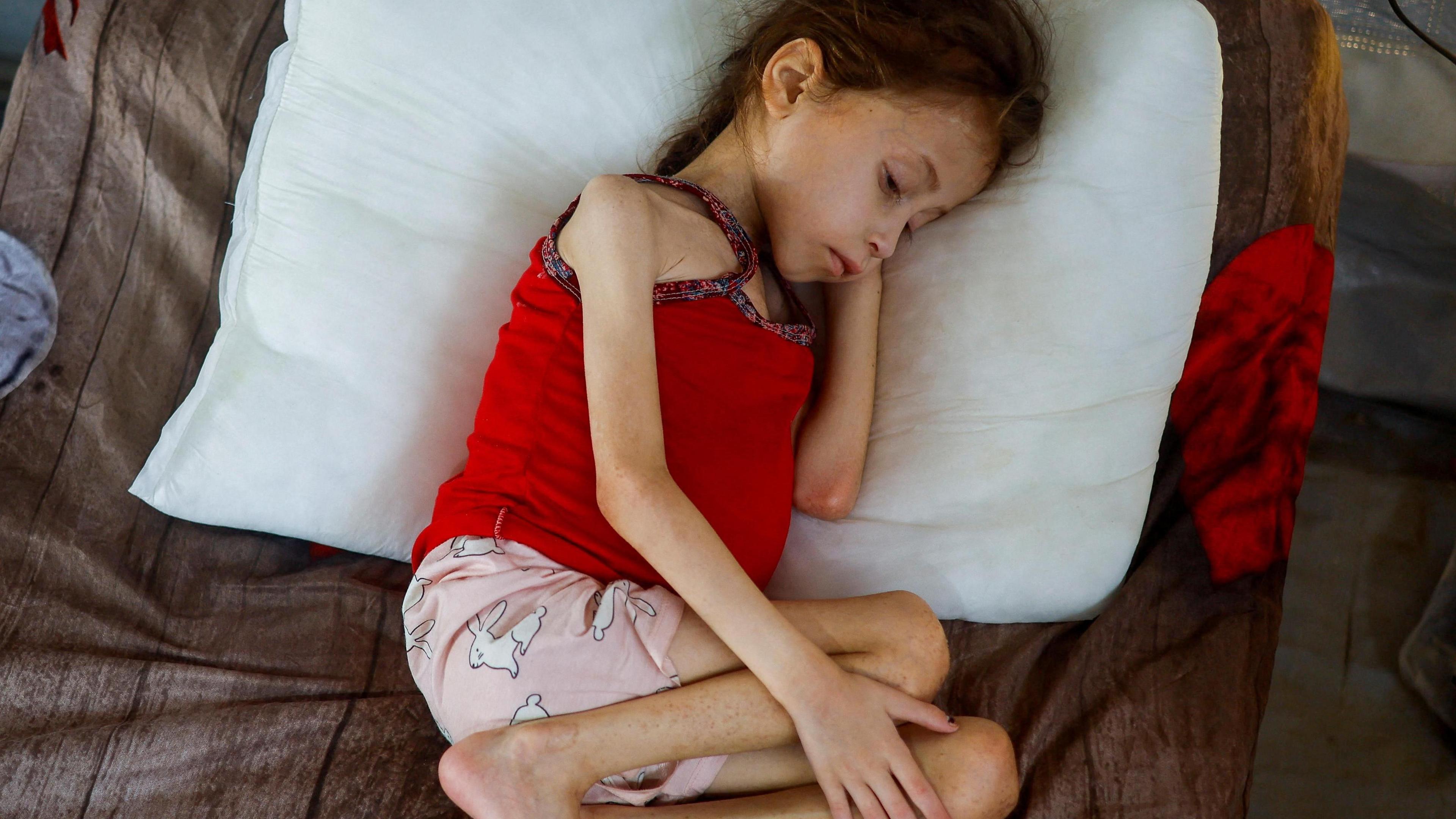 A Palestinian girl Jana Ayad, who is malnourished, according to medics, rests on a bed as she receives treatment at the International Medical Corps field hospital.