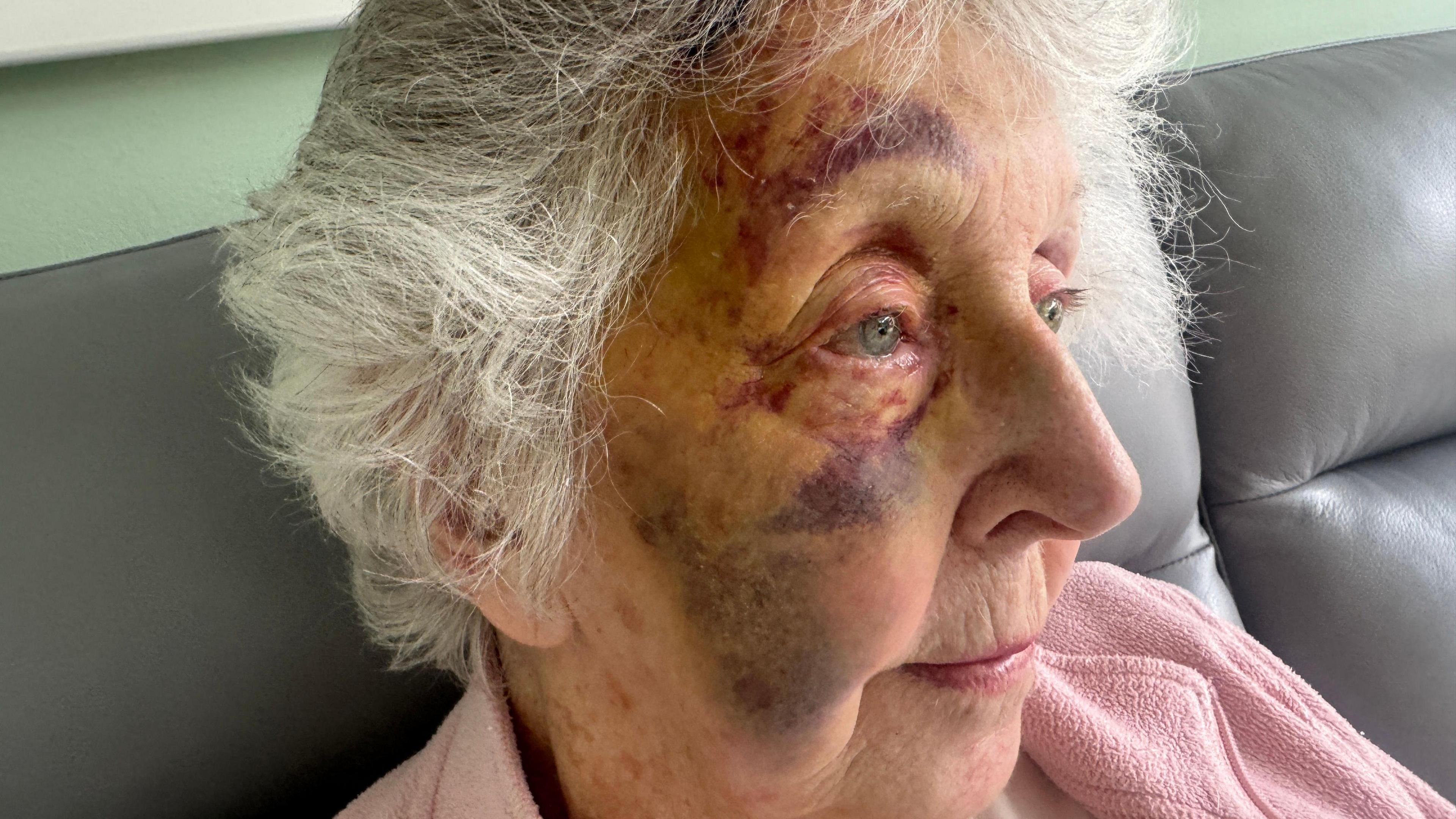 An elderly lady with a significant bruise covering most of her face, she has white hair and is wearing a pink jumper. It is a close up photo and is to the side of her face.