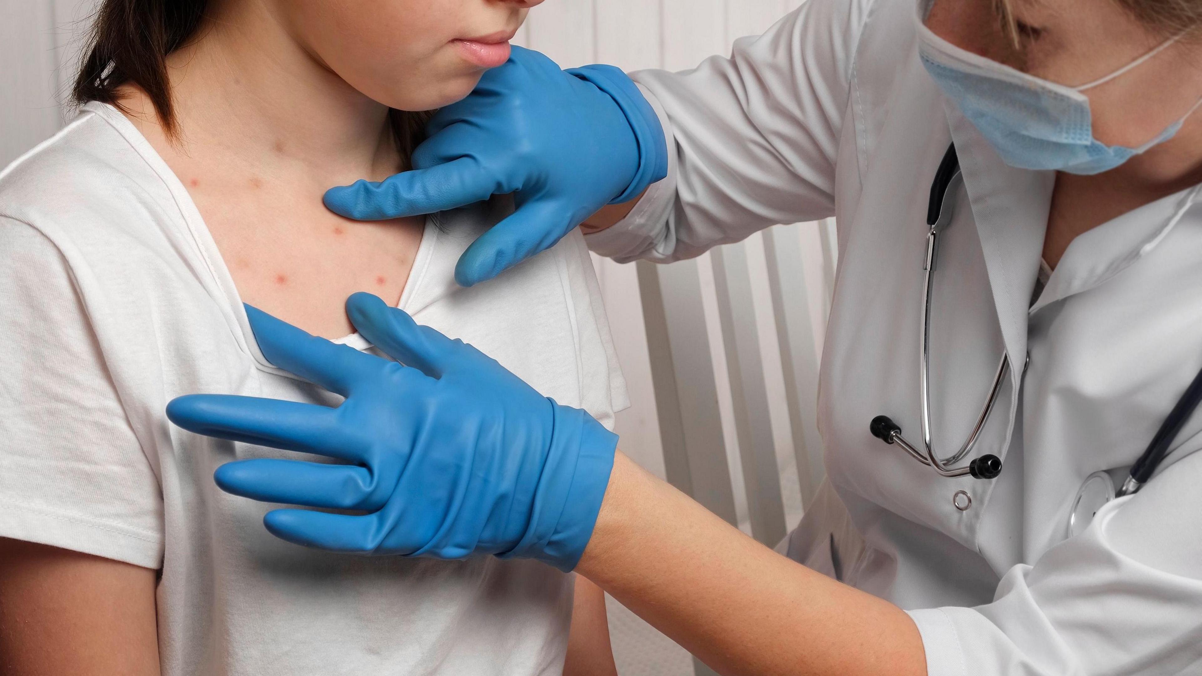 A female doctor wearing a white uniform, stethoscope around her neck, blue mask and blue latex gloves. She is pulling back the t-shirt of a patient to check the young girl's chest for a measles rash, which are small red spots. 