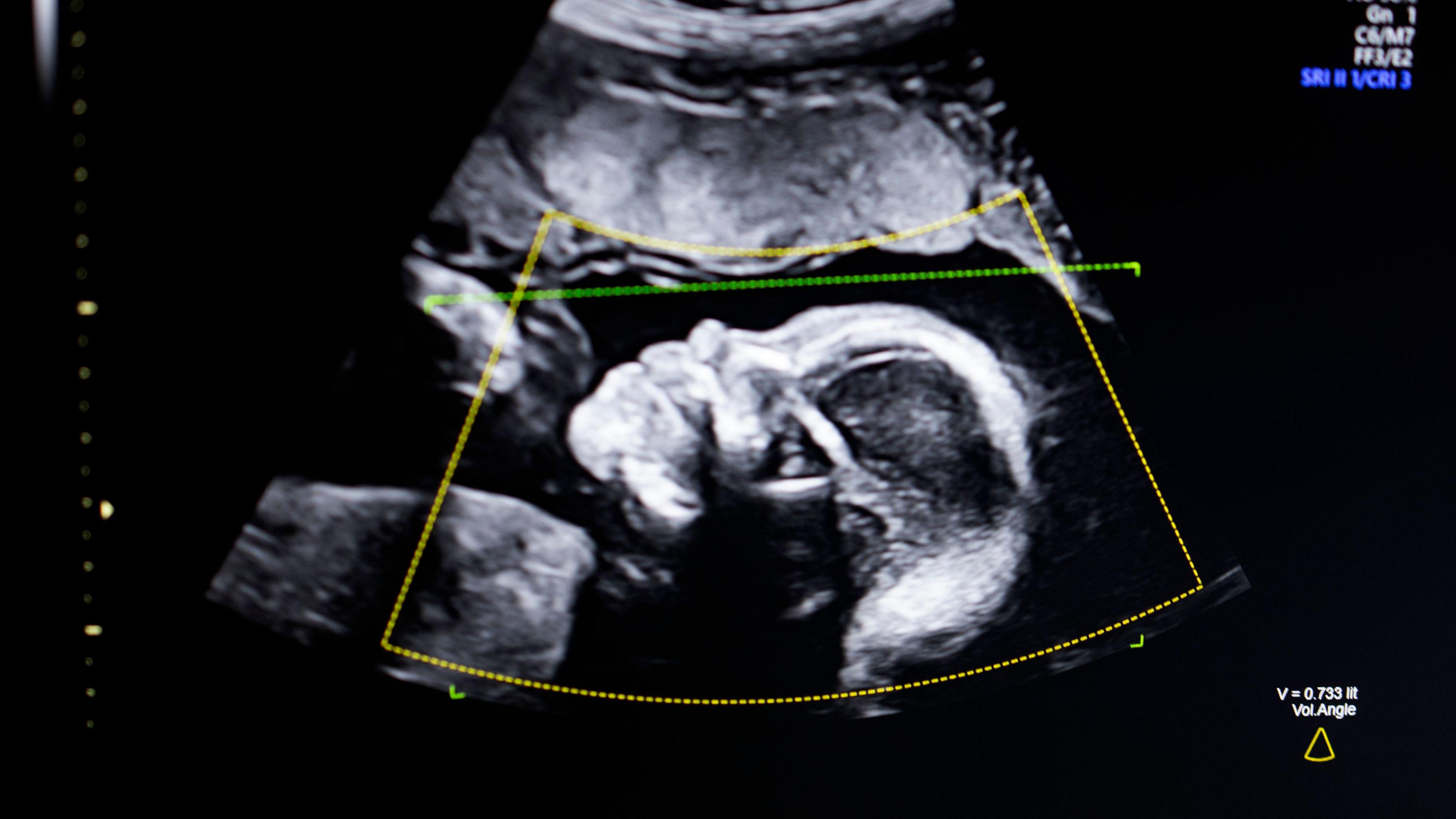 An image of a baby's head shown on screen on an ultrasound scan. It is a grainy black-and-white image of the side of the head. You can clearly see the nose and eyes. Overlaid on the top of the image are data from the imaging machine including a yellow box and a green dotted line.