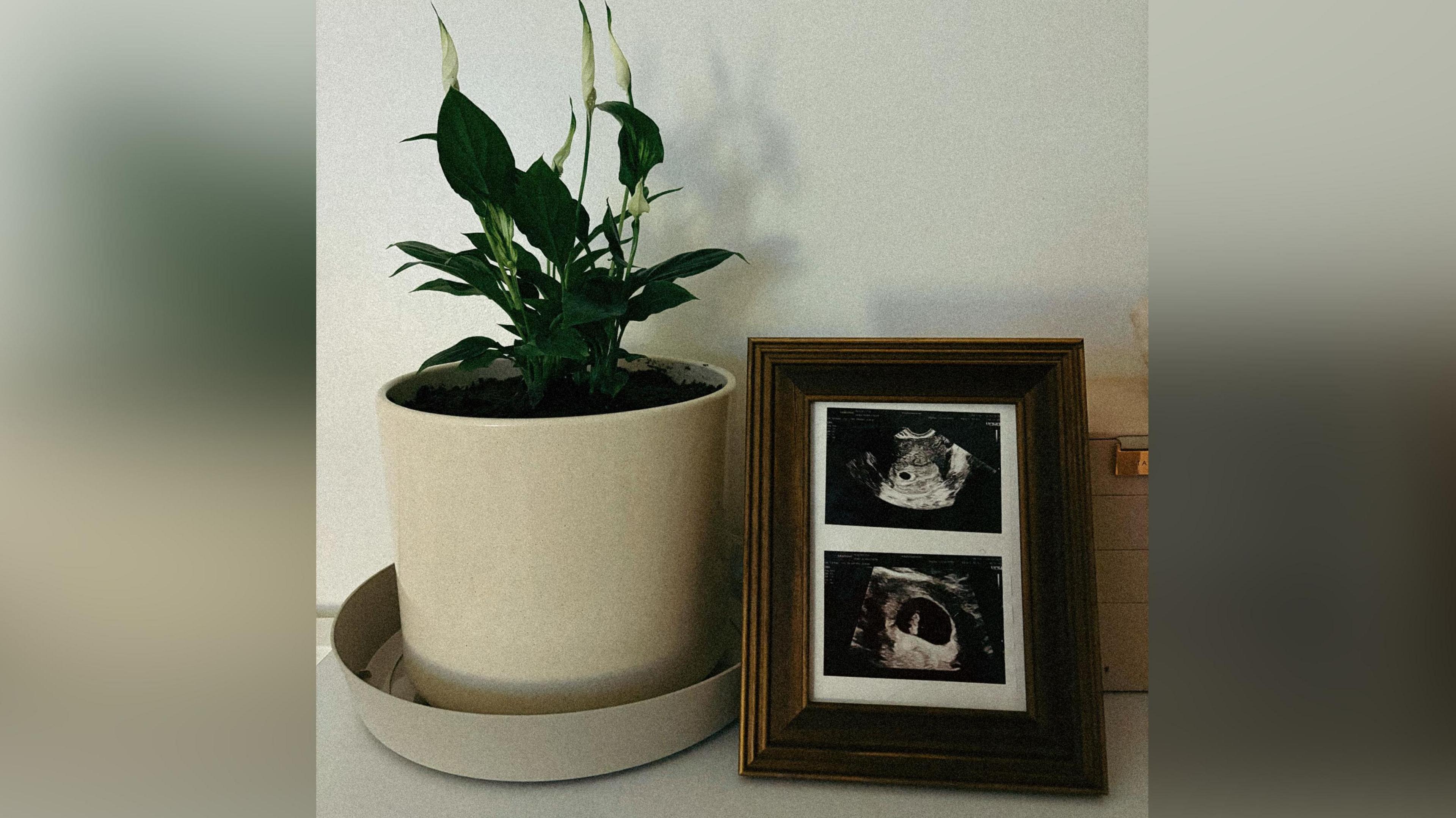 Llun sgan o fabi alaw yn y groth