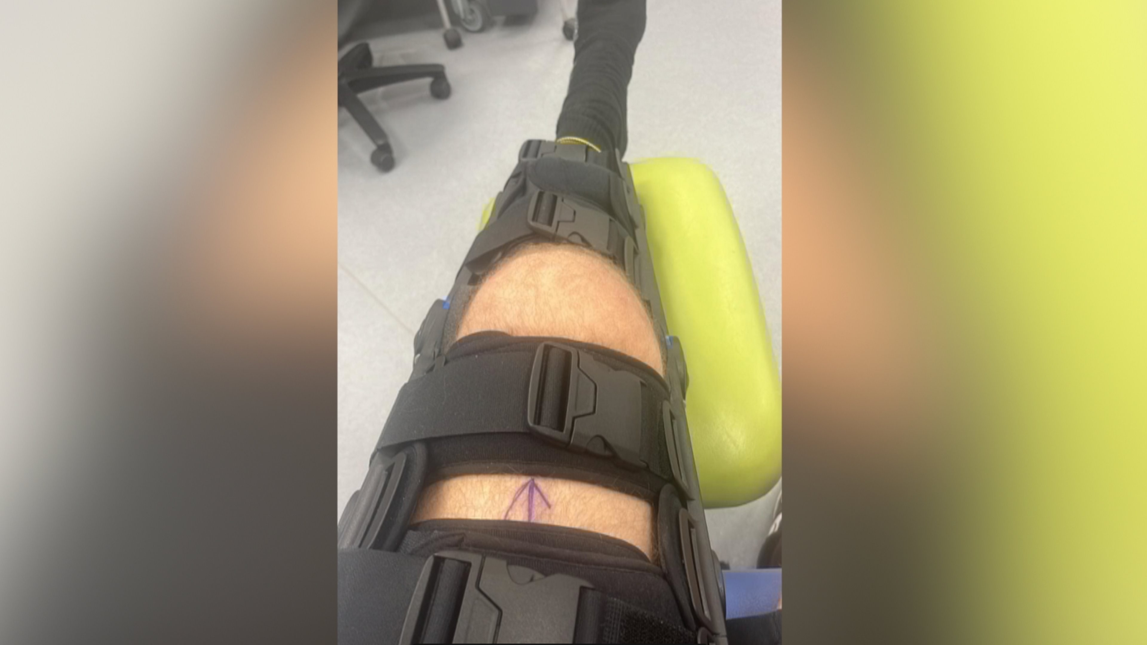 Joel Collins' injured leg is seen in a cast in hospital