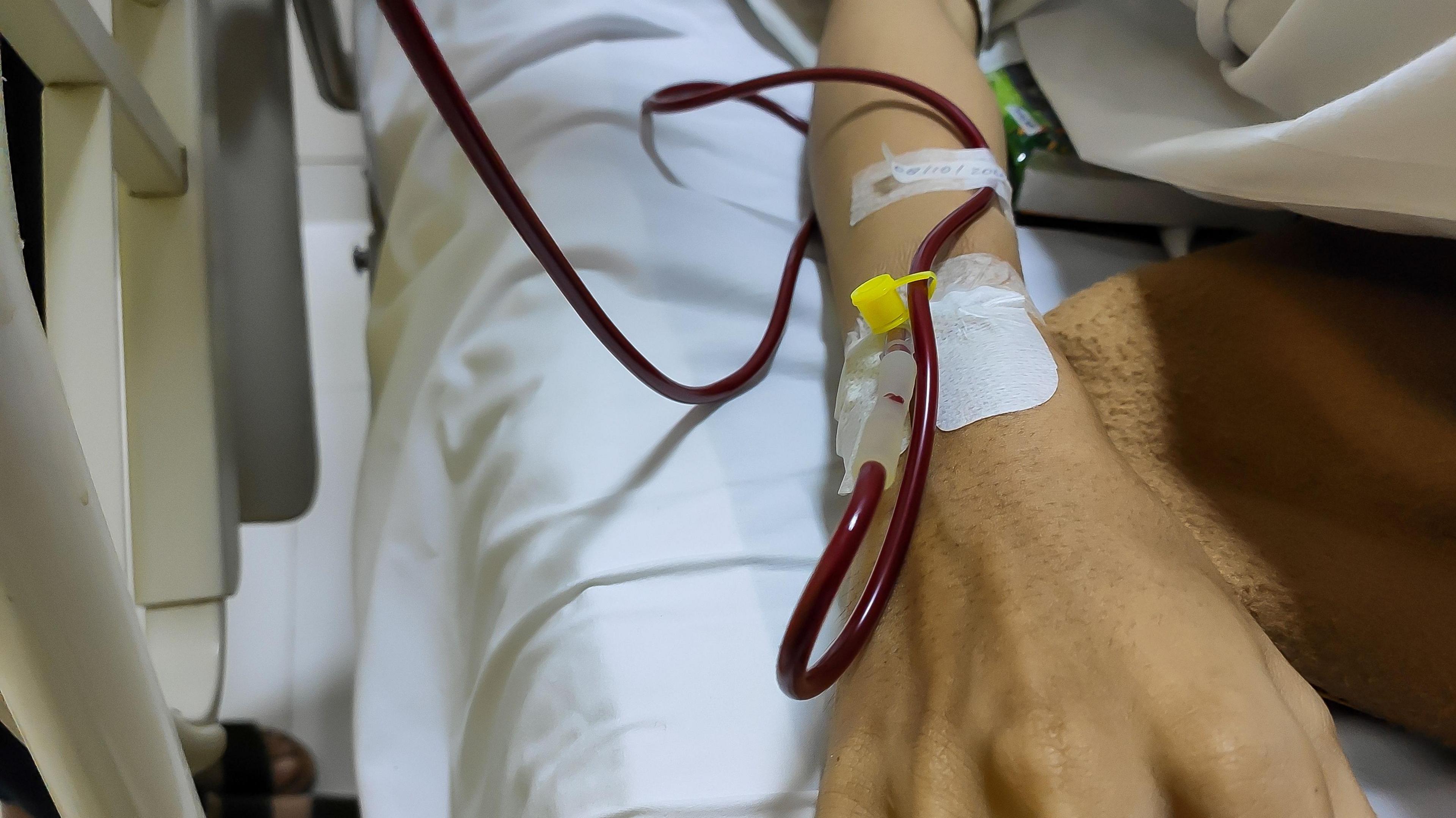 A close up view of hand receiving blood transfusion
