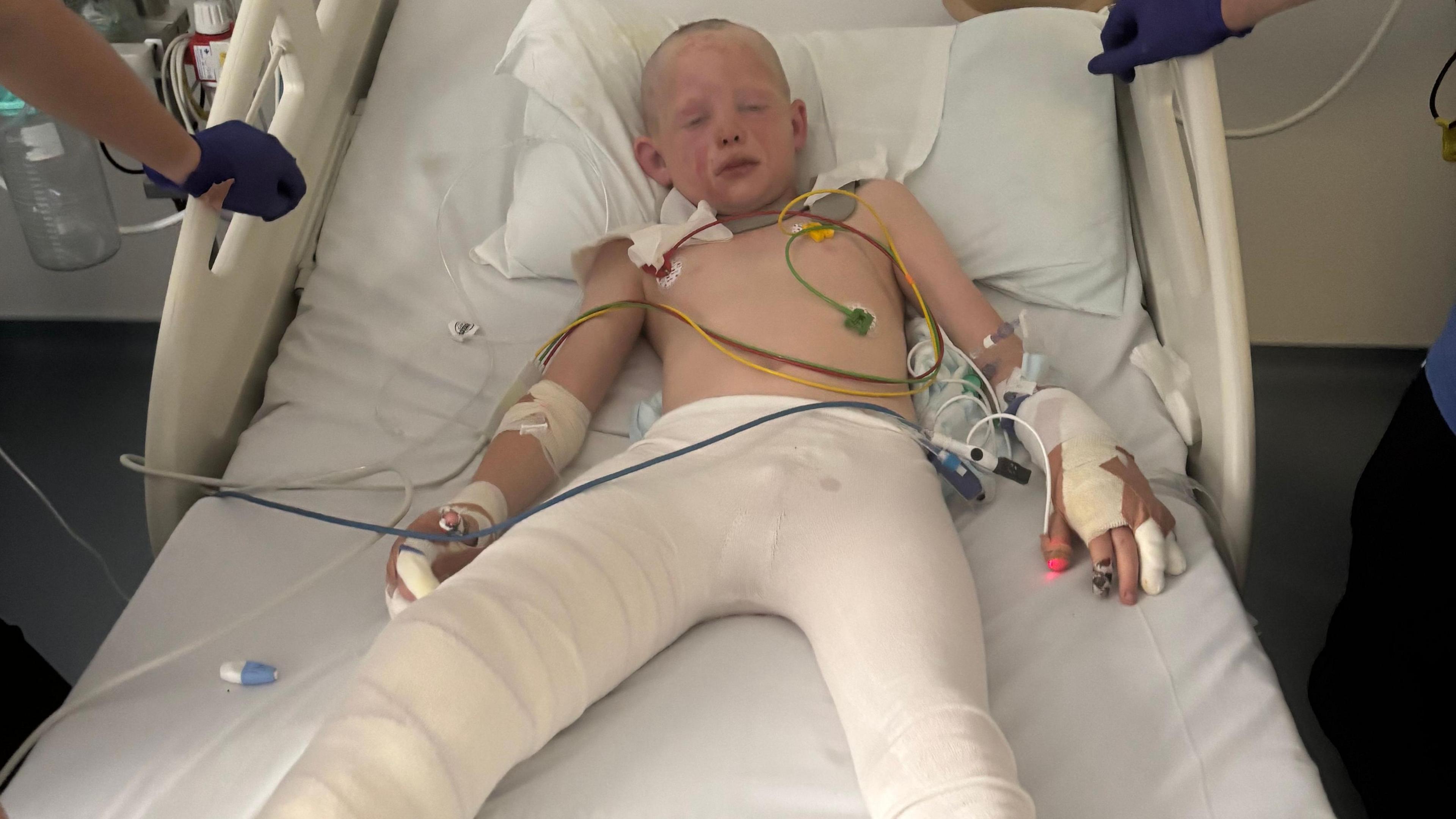 Boy lying in hospital with legs bandaged