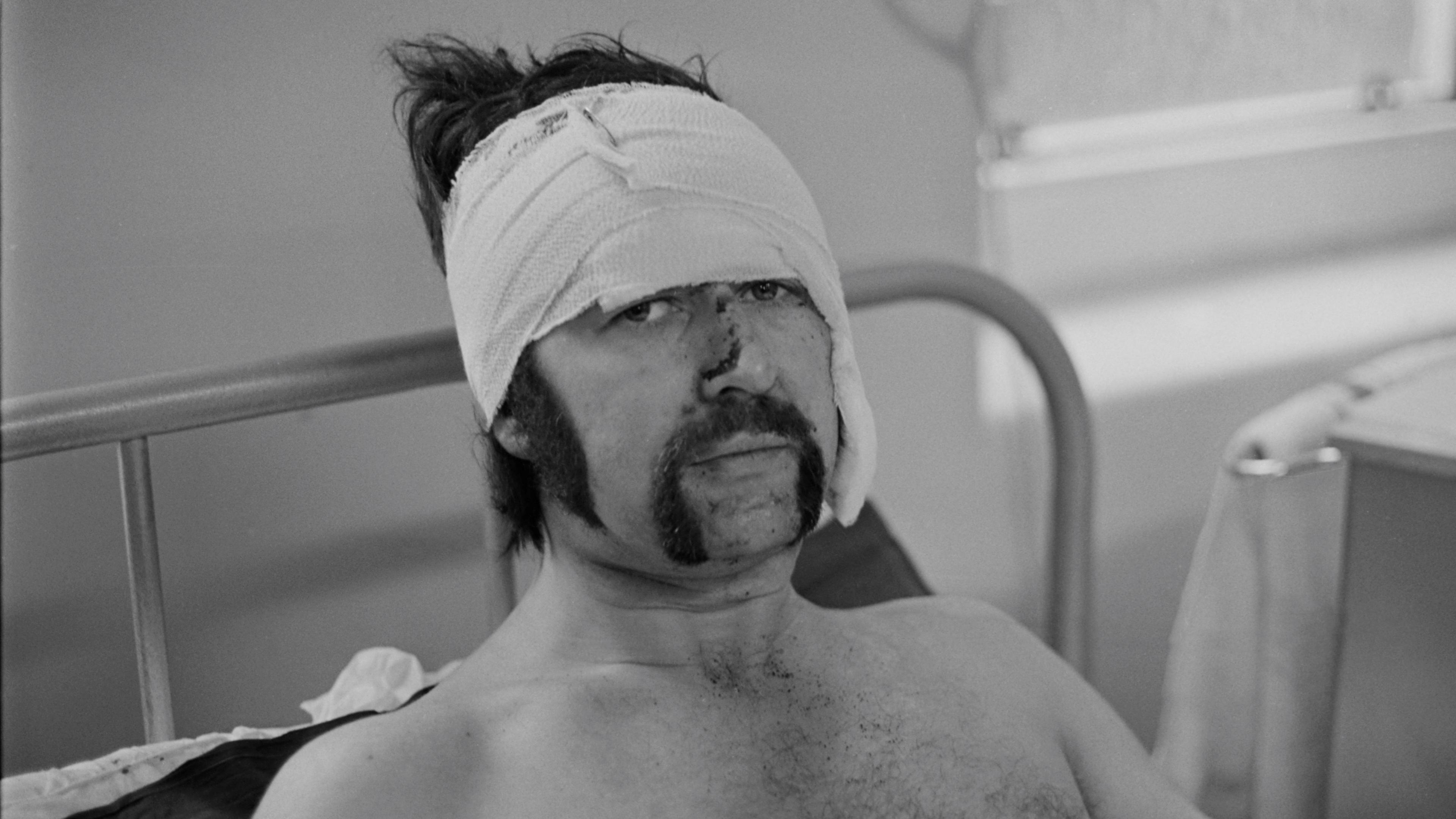 A man with a large bandage wrapped around his head and some of his face looks at the camera. He has dark hair and a dark handlebar moustache, and visible injuries on his nose. Behind him is the metal frame of a hospital bed.