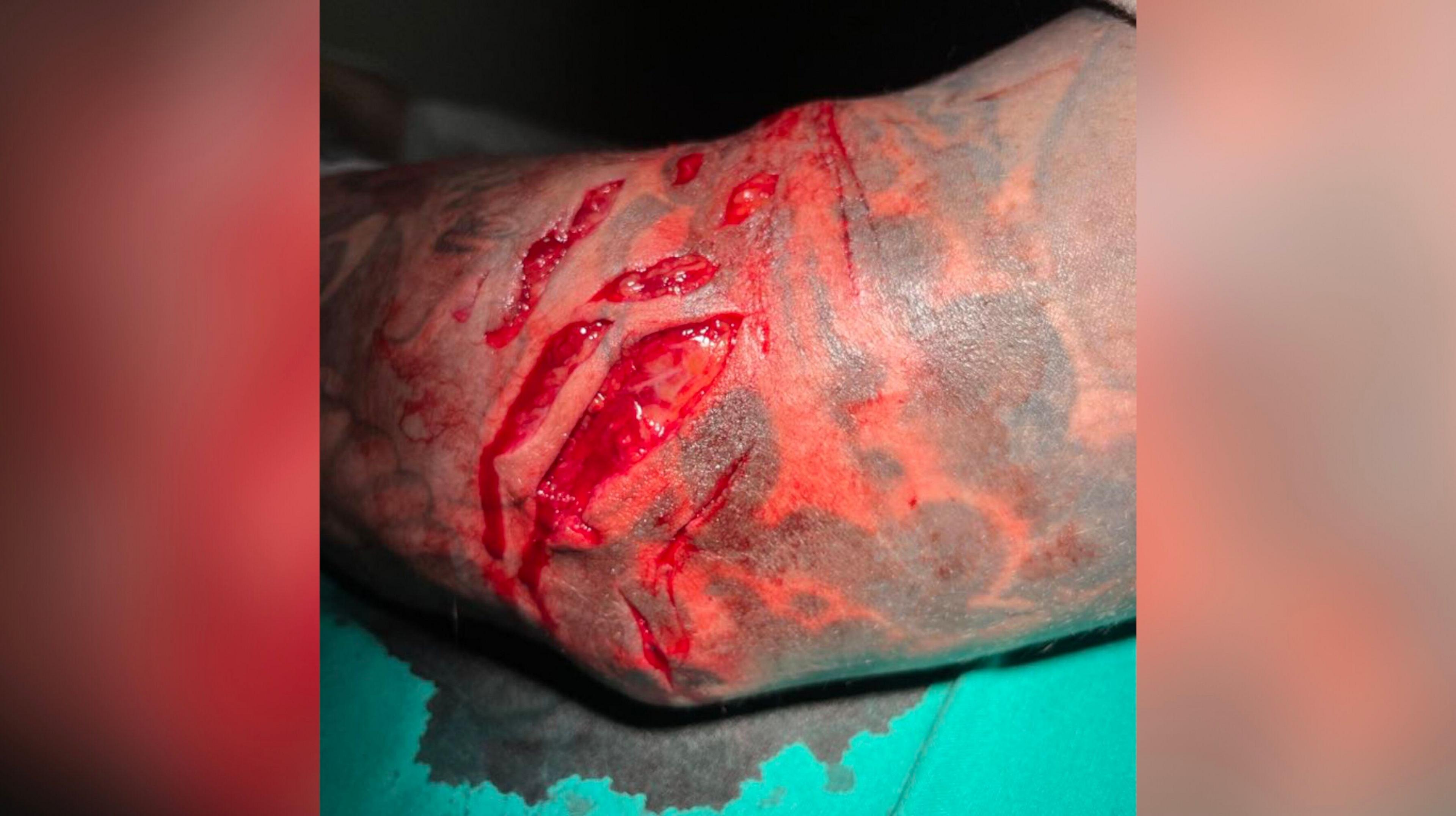 Photo of numerous wounds to an arm, near the elbow