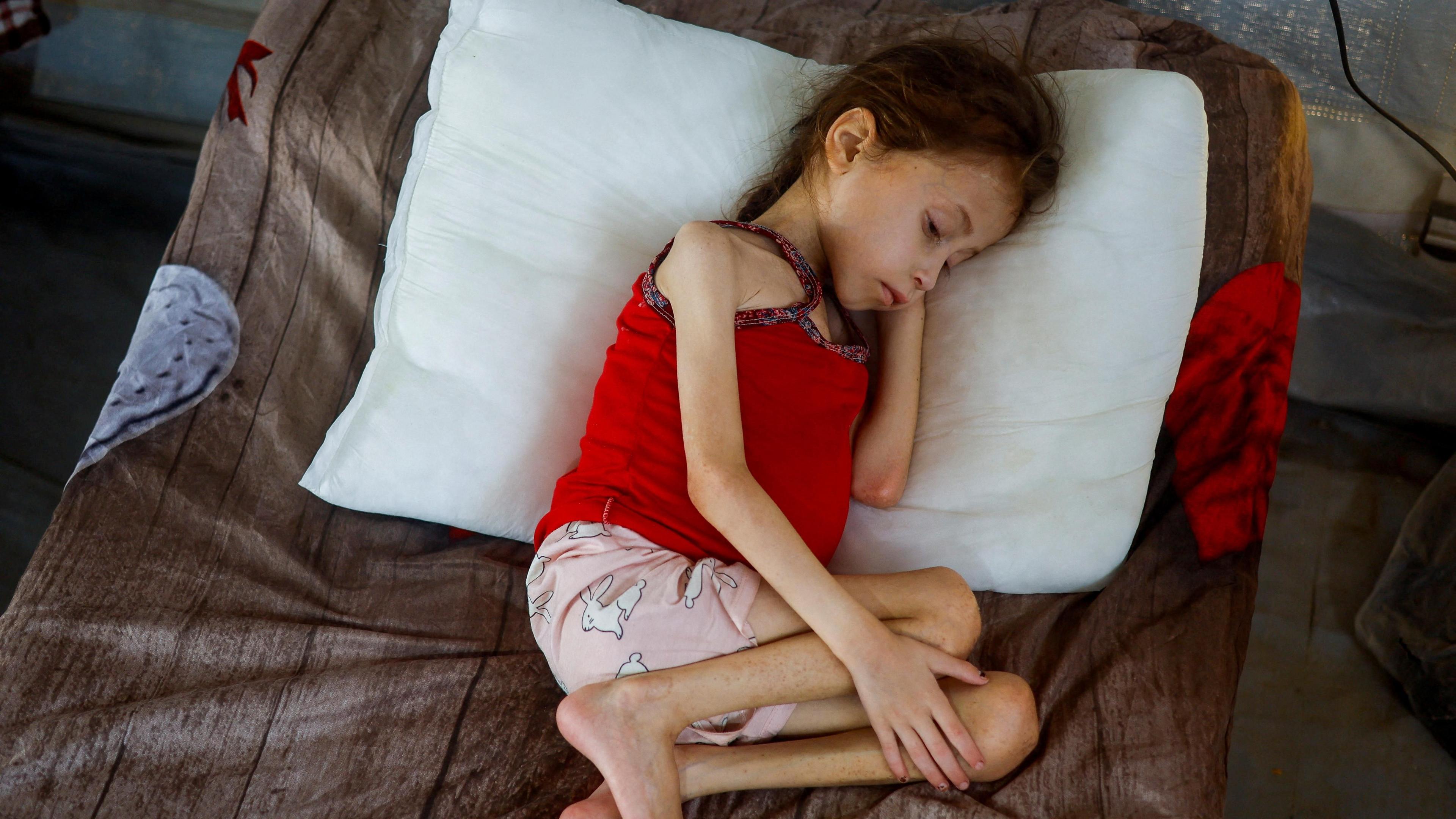 Jana Ayad, a Palestinian girl wears a red vest and pink shorts, her thin arms and legs folded on a bed. She is malnourished, according to medics at the International Medical Corps field hospital, amid the Israel-Hamas conflict, in Deir Al-Balah, southern Gaza strip.