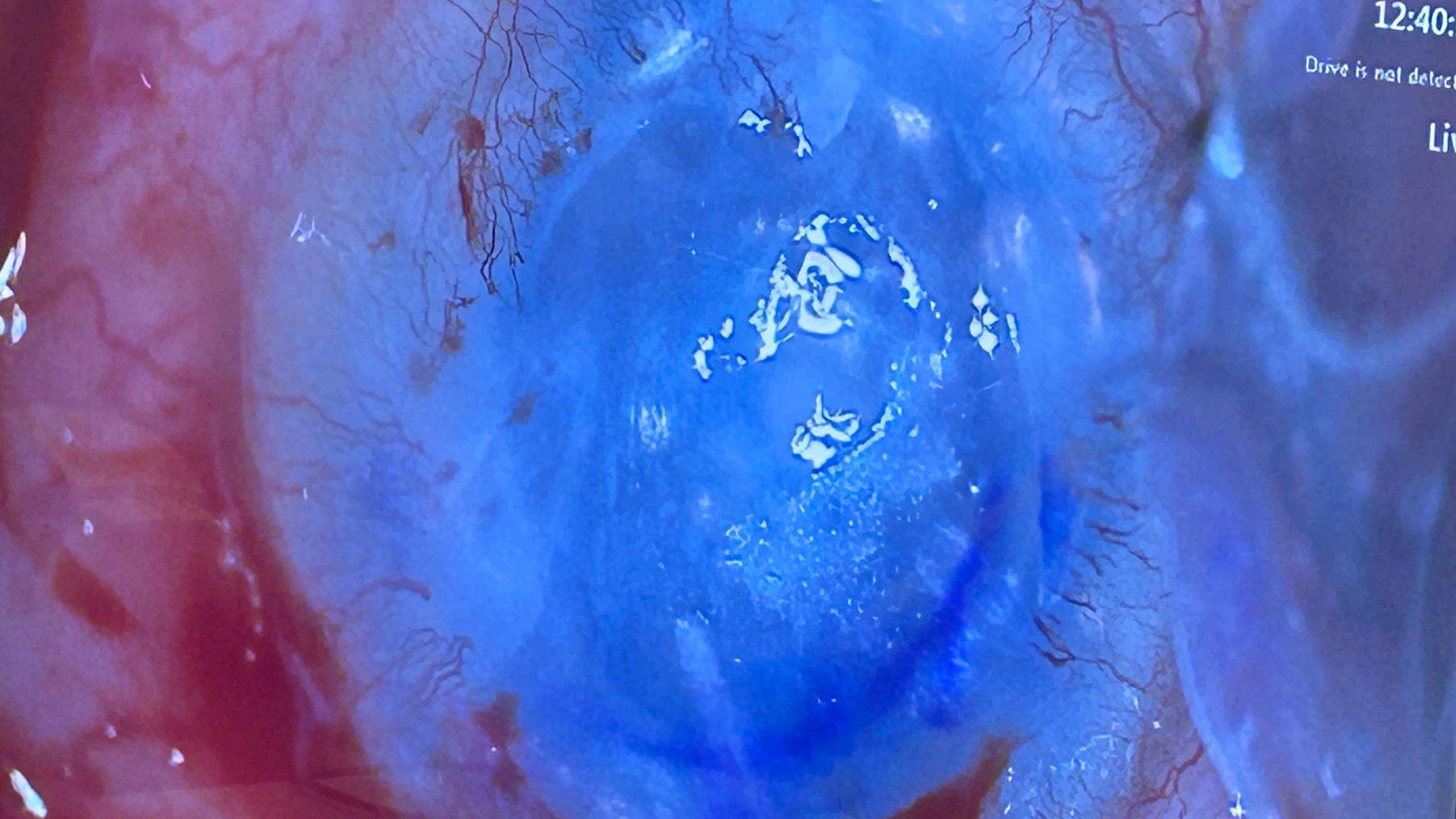 A picture showing the artificial cornea on the human eye