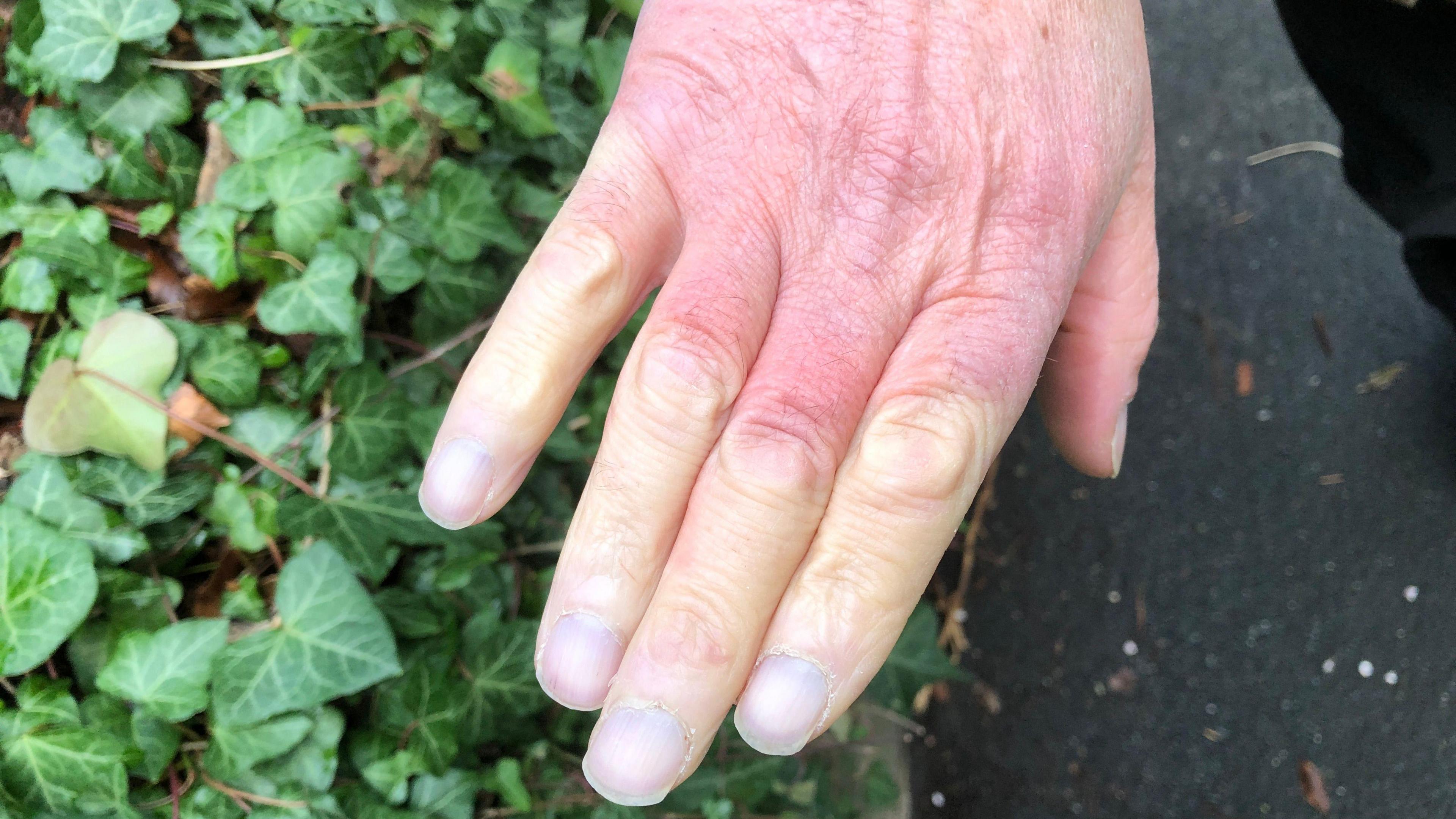 The hand of a man is pictured. Three quarters of his fingers lack colour and have turned white due to Raynaud's disease